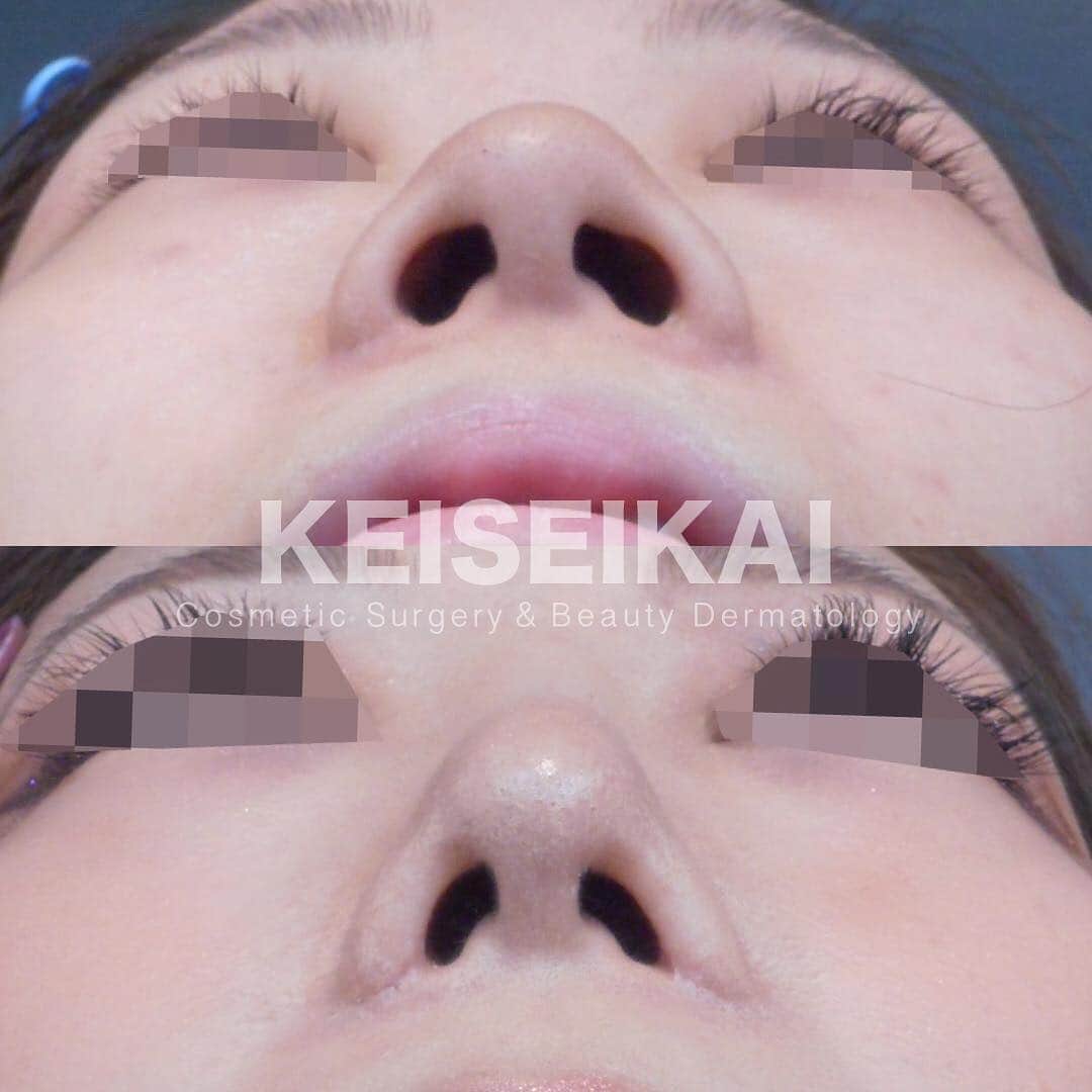 恵聖会クリニックさんのインスタグラム写真 - (恵聖会クリニックInstagram)「⠀ ＼美鼻モニター様／ ⠀ ▫️以前他院で小鼻縮小をしたけどもう少し小さくしたい ▫️鼻のバランスを整えたい ▫️鼻先をスッキリさせて高さを出したい と希望され ・鼻プロテーゼ ・鼻尖形成 ・耳介軟骨移植による鼻中隔延長 ・小鼻縮小 中間法 を受けられました。 ⠀ 1枚目→左：施術前  右：施術3ヶ月後 2,3枚目→上：施術前  下：施術3ヶ月後 ⠀ 他院で受けられた手術の修正も行っておりますので、お気軽にご相談ください。 ⠀ 💴鼻プロテーゼ：150,000円 💴鼻尖形成：250,000円 💴耳介軟骨による鼻中隔延長：300,000円 💴小鼻縮小 中間法：180,000円 🈹4施術同時割引：10%OFF 計792,000円 ※税抜表示 ⠀ ⚠️リスク：腫れ・浮腫・内出血・感染症・血腫 ⠀ #美鼻 #鼻整形 #プロテーゼ #鼻プロテーゼ #隆鼻術 #鼻を高く #鼻を高くしたい #鼻尖形成 #小鼻縮小 #鼻翼縮小 #鼻中隔延長 #団子鼻 #だんご鼻 #整形 #美容整形 #ビフォーアフター #症例写真 #恵聖モニター #モニター募集 #モニター募集中 #恵聖会クリニック #美容外科 #美容クリニック #大阪 #心斎橋 #京橋」3月29日 18時08分 - keiseikai