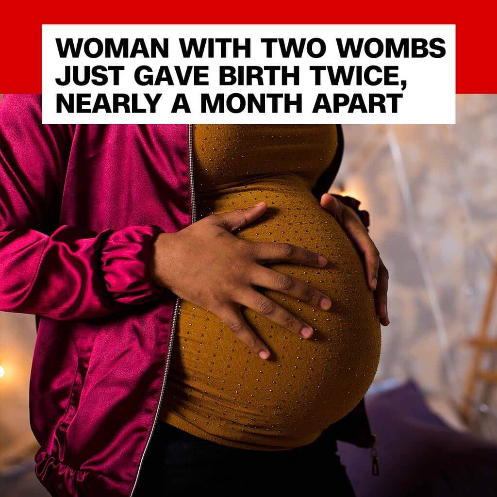 CNNさんのインスタグラム写真 - (CNNInstagram)「A month after giving birth, a 20-year-old Bangladeshi woman returned to a hospital complaining of lower abdominal pain. Then she gave birth to twins from her second uterus. Arifa Sultana has two uteruses, a condition called uterus didelphys. She didn't get an ultrasound before the first delivery, so it was missed, said Dr. Sheila Poddar. "All three children are safe and healthy," Poddar said. "The mother is also fine." (📸: Shutterstock)」3月29日 22時32分 - cnn