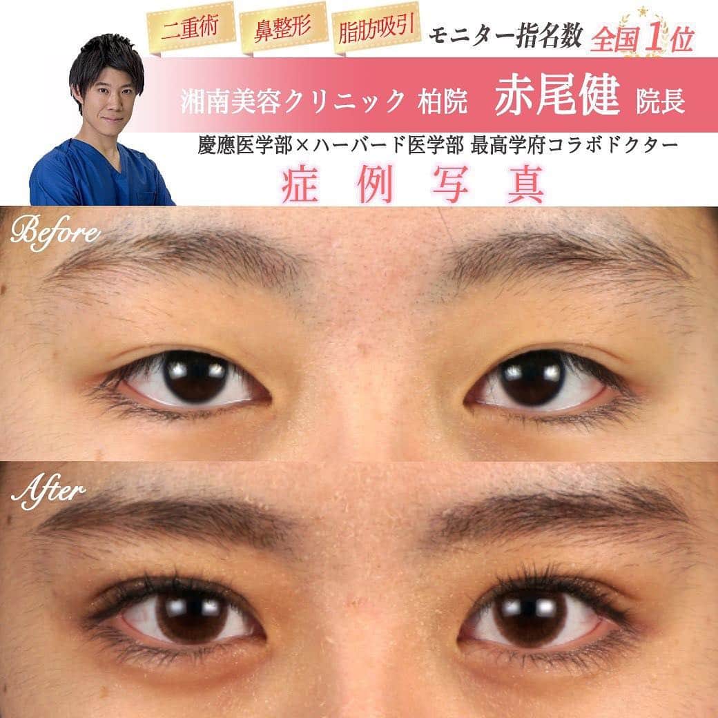 湘南美容外科 柏院さんのインスタグラム写真 - (湘南美容外科 柏院Instagram)「✨✨毎日ご指名殺到✨✨ ⠀⠀⠀⠀⠀⠀⠀⠀⠀⠀⠀⠀⠀⠀⠀⠀ モニターランキング👑 三冠王👑赤尾院長です。 ⠀⠀⠀⠀⠀⠀⠀⠀⠀⠀⠀⠀⠀⠀⠀⠀ いつもご指名頂きありがとうございます❣️😊 ⠀⠀⠀⠀⠀⠀⠀⠀⠀⠀⠀⠀⠀⠀⠀⠀ お写真は【埋没法二重術】を 受けられたお客様です👀💕 とっても可愛く変身されました🤗🍒 ⠀⠀⠀⠀⠀⠀⠀⠀⠀⠀⠀⠀⠀⠀⠀⠀ ❤️アイプチ・アイテープ生活から開放される！ 🧡すっぴんでも二重♪ 💛メイクが楽しくなる ⠀⠀⠀⠀⠀⠀⠀⠀⠀⠀⠀⠀⠀⠀⠀⠀ ⠀⠀⠀⠀⠀⠀⠀⠀⠀⠀⠀⠀⠀⠀⠀⠀ 目が変わるだけで気持ちも明るくなれますよね☀️😋 一度きりの人生、楽しみませんか？🌷 ⠀⠀⠀⠀⠀⠀⠀⠀⠀⠀⠀⠀⠀⠀⠀⠀ 目・お鼻や脂肪吸引✨ さらにバストアップ👙✨など 赤尾院長にお気軽にご相談下さい😘 ⠀⠀⠀⠀⠀⠀⠀⠀⠀⠀⠀⠀⠀⠀⠀⠀ ご予約はコチラ↓↓↓ お電話0120-489-750📲✨ またはメール📩✨ ⠀⠀⠀⠀⠀⠀⠀⠀⠀⠀⠀⠀⠀⠀⠀⠀ 必ず‼️ 『柏院のインスタ見た‼️赤尾院長指名👨‍⚕️』 とお伝え下さい😊✨ 合わせて【モニターNo.020-0526】もお伝えいただくとご案内がスムーズです👌🏻 ⠀⠀⠀⠀⠀⠀⠀⠀⠀⠀⠀⠀⠀⠀⠀⠀ ⠀⠀⠀⠀⠀⠀⠀⠀⠀⠀⠀⠀⠀⠀⠀⠀ ⚠️Dr.赤尾の予約はほぼご指名で埋まってるので、ご予約はお早めにお願いします✨🙇 ＿＿＿＿＿＿＿＿＿＿＿＿＿＿＿＿＿＿＿＿ 🔶赤尾院長の出勤日🔶 ⠀⠀⠀⠀⠀⠀⠀⠀⠀⠀⠀⠀⠀⠀⠀⠀ ３月🎓 1.2.3.4.5.6.8.9.10.11.16.17.19.20.21.22.23.24.25.26.27.29.30.31 ⠀⠀⠀⠀⠀⠀⠀⠀⠀⠀⠀⠀⠀⠀⠀⠀ ４月🌸 2.3.5.6.7.8.9.10.11.12.13.14.19.20.21.23.24.26.27.28.29.30 ⠀⠀⠀⠀⠀⠀⠀⠀⠀⠀⠀⠀⠀⠀⠀⠀ ５月🍃 1.2.3.4.5.6.9.10.11.12.13.16.17.18.19.21.24.25.26.27.30.31 ＿＿＿＿＿＿＿＿＿＿＿＿＿＿＿＿＿＿＿＿ @sbc_akao ⠀⠀⠀⠀⠀⠀⠀⠀⠀⠀⠀⠀⠀⠀⠀⠀ #湘南美容#美容外科#かわいい#followme#l4l#撮影#セルカ #me #モデル#メイク#カラコン#マツエク#美人#整形#プチ整形 #韓国#オルチャン#韓国好きな人と繋がりたい#スタイルナンダ#cute #美容#美肌#レーザー#二重#二重整形 #涙袋#柏#千葉#2 ⠀⠀⠀⠀⠀⠀⠀⠀⠀⠀⠀⠀⠀⠀⠀⠀ ※施術の副作用（リスク） 痛み 腫れ 内出血 傷跡(赤み) つっぱり 食い込み  左右差 糸玉 ゴロつき 結膜出血 角膜障害 感染 眼瞼下垂 ⠀⠀⠀⠀⠀⠀⠀⠀⠀⠀⠀⠀⠀⠀⠀⠀ 埋没法二重術 定価 ¥5,620〜¥299,560」3月30日 18時16分 - sbc_kashiwa