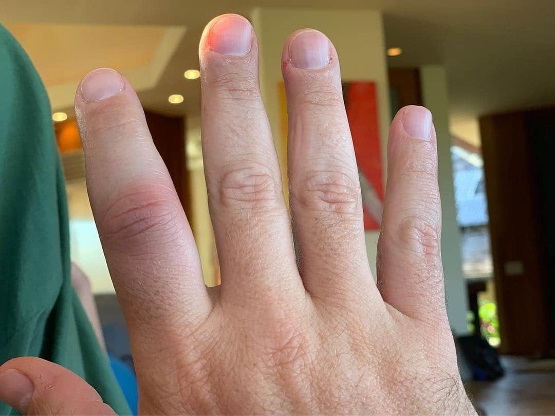 ネイサン・フィリオンさんのインスタグラム写真 - (ネイサン・フィリオンInstagram)「Guess which finger hurts like hell.」3月31日 2時49分 - nathanfillion