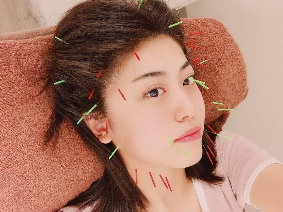 のインスタグラム：「‎⋆ 衝撃写真すみません🤭笑 以前一緒にお仕事した、星かおるちゃん(@kaoru_315) の弟さんの鍼灸サロンに行ってきました♥ この後、新しく宣材写真を撮り直して来たよー🤗 ‎⋆ 前日の地方ロケでバキバキだった体もしっかり ほぐしてもらってから、初の #美容鍼 ！！ ずっとやってみたかった～☺️ 美容鍼、写真のインパクトの割に全っ然痛くないです🙆🏻 むしろ、いつも自分の美顔器でバチバチにEMS当ててる からそっちの方が痛い。笑 だから全然大丈夫でした♥ ‎⋆ サロンもすごく綺麗で落ち着ける空間！ ウェルカムボード嬉しかったです💕 かおるちゃんも弟さんもありがとうございました✨ ‎⋆ ‎‎⋆ #三軒茶屋鍼灸サロンsinas #sinas #美容鍼 #美容 #小顔矯正 #小顔 #フェイシャル #ボディメンテ #メンテナンス #鍼灸サロン #三軒茶屋」