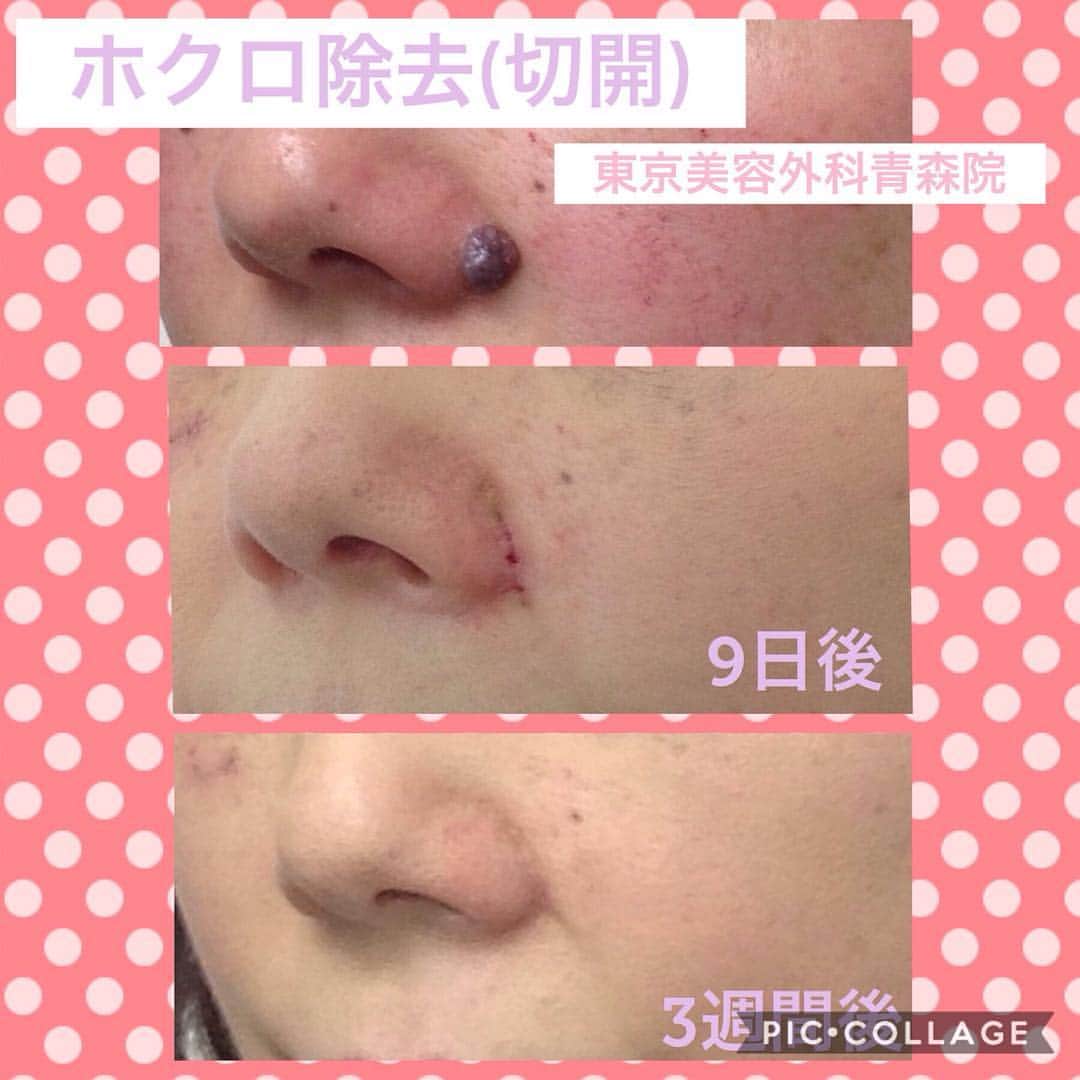 東京美容外科公式さんのインスタグラム写真 - (東京美容外科公式Instagram)「こんにちは✨ 青森院です🍎 . こちらはホクロ切開の術後の経過のお写真です。 . 綺麗に切除され、縫合されているため抜糸時は目立つ傷になりますが、美容外科的処置で傷はしわと同化しほとんどわからなくなります🤗 . . 💡リスクと術後の注意点‼️ たいていの場合1週間ほどで腫れはひきます。 内出血がおこる場合があります。始めは黒ずみますが約1〜2週間で引いていきます。 . お悩みの方、是非ご相談くださいませ😊💕 4月まだまだご予約受け付けております☘ . . . ==🎁お問い合わせはこちら🎁==== 詳しくはプロフィールのURLから公式サイトへ♪ ▼フリーダイヤル 0120-658-958 （コールセンター受付時間：9：00～21：00） ▼LINE予約 @ tkc110 ============== #東京美容外科 #東京美容外科赤坂院 #審美 #美容整形 #きれい #整形 #美活 #綺麗になりたい #美肌 #美意識  #美容外科 #プチ整形 #インビザライン#アンチエイジング #美容好き #歯科ドッグ #美容整形外科 #二重 #埋没法 #タルミ #小顔 #目の下のくま #涙袋 #ピーリング#ホクロ除去 #ホクロ#切開#青森市」4月3日 14時23分 - tokyobiyougeka_jimukyoku