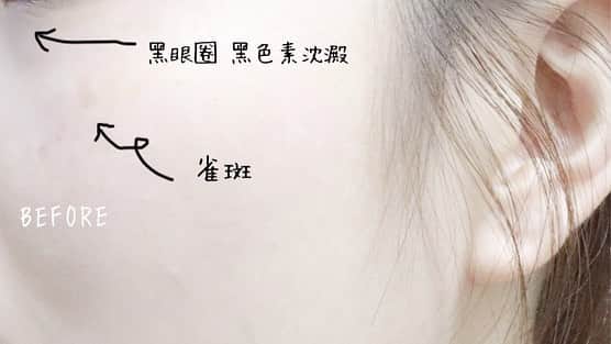 HauTung 巧童在這さんのインスタグラム写真 - (HauTung 巧童在這Instagram)「/ 用家超級詳文 ((向後拉有小小小影片喔 一直都深受雀斑同黑眼圈問題所困擾 以為平常睡眠不足和睡眠品質所影響💤 但與顧問資訊後 才發現原來我皮膚底層有許多微絲血管爆裂及黑色素 所以要從根本入手才能解決問題  於是 顧問建議使用OPT ™️/ Resur FX ™️深層解決肌膚問題  1/ 雀斑及色素問題全面使用了Lumenis M22 的 OPT™️ 使用時第一ROUND會暖暖的 第二ROUND則像被橡筋彈哈哈 當然越接近色素的位置 感覺會加深 整個過程我是能接受的✌🏻肌膚因吸收特定波長的光能後轉化成熱能被破壞✨輕鬆改善日曬色斑、微絲血管顯現等護理  2/ 黑眼圈問題使用了Resur FX ™️ 以打印方式進行治療 採用Erbium 1565nm 光纖激光和最先進獨有專利的 Coolscan 掃描技術 可以深層刺激肌膚膠原增生和改善膚質✨✨尤其是減淡眼部的色素沈澱阿 (!) 一星期內色素就會開始凋落  基本上是暫時看不到有什麼特別的不同的地方 因為它是先處理你底層的問題 容易令你表面的肌膚變好 (( 但總覺得皮膚有變得透亮光滑👀🙈 . @ttuaclub  https://www.ttuac.com.hk/ 立即查詢：27884998 / 68816662 敏感泛紅 | 色斑 | 暗瘡 | 毛孔粗大 | 紋理 | 疤痕 | 痣癦 | 多餘毛髮 | 膚色不均 | 乾燥」4月3日 15時49分 - hautunnng