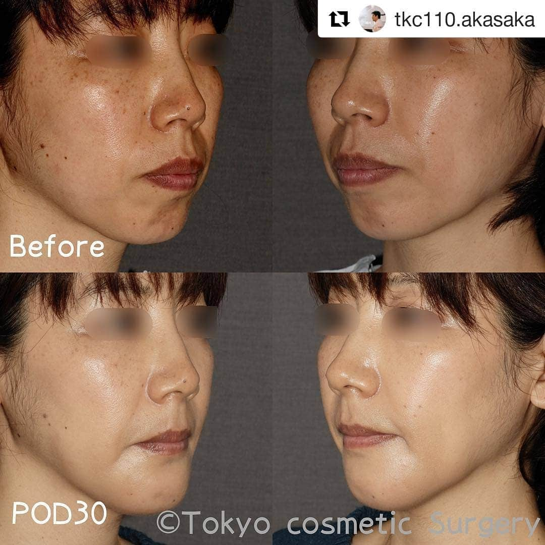 東京美容外科公式さんのインスタグラム写真 - (東京美容外科公式Instagram)「宮崎医師の「セットバック」「オトガイ形成術」の術後30日の症例のご紹介です。 #Repost @tkc110.akasaka (@get_repost) ・・・ ・ 今回ご紹介するのは先日の続きです。 口元のこんもりとした感じ、 ゴボ口を改善させたいと 相談に来られた患者様です。 ・ 彼女に行った施術は 「セットバック」 「オトガイ形成術」 ・ 口元の変化が及ぼす影響ですが、 法令線の見え方が変わります。 口角も後ろに下がり、 厚ぼったかった唇も 薄くなってすっきりとします。 下唇とあご先までのくびれができます。 ・ 術後30日目だとまだあご先の腫れが残っているので、 あごが大きく、そして長く感じますが、 3か月目あたりまでには落ち着いてきます。 今まで口元が突出してあごが後退していたので、 そのバランスに見慣れていたと思います。 口元が後退してあごが前に出てくると、 どうしてもあごが長くなったと思う方が 多くいらっしゃいます。 腫れが引いてこのバランスに見慣れてくると 違和感を感じなくなります。 ・ 🎯🎯ゴボ口を改善させる骨切り手術です。前方分節骨切り術で突出した口元を改善させます。術後に歯列矯正で歯並びを直す必要がある手術です。 ⏱⏱手術時間は3時間程度。 ⏳⏳術後の腫れは2週間で7割引いています。1か月でほとんど腫れは収まっています。あご先が引き締まった感じが出るのには、2か月以上経過した辺りです。 💰💰1,898,000円、別途術前検査代、麻酔代がかかります。術後の歯列矯正も歯科受診時に必要です。 ・ 🎉🎉🎉🎉🎉🎉🎉 ・ ・ ・ ＊結果には個人差があります。内出血や感染などの合併症を認めた場合、治癒期間に差が出ます。合併症に伴う経過についてはカウンセリングの際に説明しますので、十分納得の上で施術をご検討ください。 ・ ・ 💉 Dr. Kunio Miyazaki performed a bone surgery with an anterior segmental osteotomy and a genioplasty. 📸 These after pictures were taken 30days after the surgery. ・ Facial contouring surgery ・ Dr. Kunio Miyazaki 東京美容外科 赤坂院 Tokyo Cosmetic Surgery Akasaka branch ・ #bonesurgery #facialcontouring #rhinoplasty #asianrhinoplasty #aestheticsurgeon #aestheticsurgery #natural #morenatural #morenaturalbeauty#akasaka #骨切り手術 #骨切り #ガミースマイル #小顔 #小顔整形 #小顔矯正 #小顔効果 #美容 #美容外科 #美容外科医 #赤坂」5月1日 18時19分 - tokyobiyougeka_jimukyoku