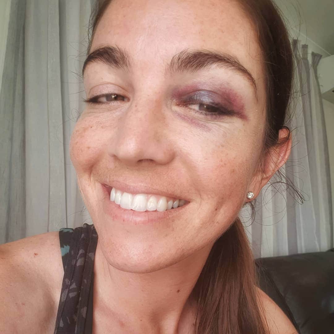 サラ・ウォーカーのインスタグラム：「My first black eye 😁😎 . To put it briefly, I jumped, went to pedal, chain popped off, fell & hit my goggles on the ground which pushed into my eye. Besides the eye, ankle, knee, hip, elbow and hands being bruised or scratched, I am all good & am excited to head to Europe tomorrow! 😂😂 #blackeye #mechanical」