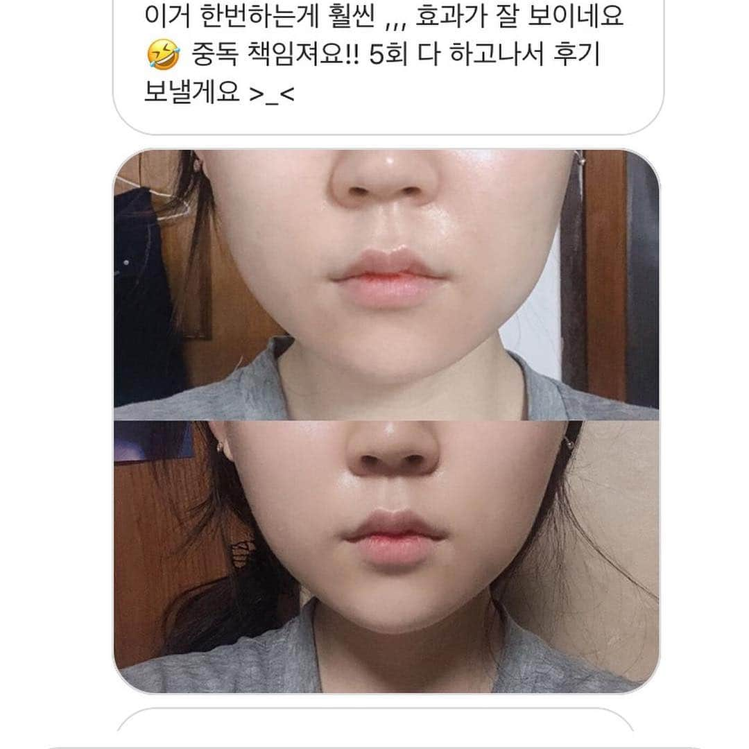 ダユンさんのインスタグラム写真 - (ダユンInstagram)「🚨 리프팅밴드 많은 후기들은 인스타 스토리 모음집 참고해주세요 ♥️ 제가 무료나눔 이벤트 진행했던 리프팅밴드 기억하시나요?! 오랫동안 저의 인스타에 #미니슈링크 와 함께 등장했던 #리프팅밴드 💛 드디어 인터넷 최저가보다 30% 할인된 가격으로 가져왔어요 ! 10일부터 12일까지 저의 인스타 프로필 링크 타고 가시면 할인 된 가격으로 구매 가능합니당 🙏🏻 평소 가격이 조금 사악해서 늘 아끼면서  촬영 날이나 특별한 날에만 썼었거든요 !  전 아무래도 안면윤곽 수술을 해서  남들보다 더 몇배로 피부 리프팅과 V라인  붓기를 신경써야 하거든요 😭 진짜 미친듯이 눈에 불키고 좋다는 여러 제품 다 써봤는데  저에게 눈에 딱 보이는 효과를 본 건 이 제품이였어요 !  아무래도 슈링크 리프팅을 개발한 회사의 제품이고  제가 미니슈링크를 썼을때도 너무 만족하고  신세계를 경험했었는데 역시나 이 리프팅밴드도  너무너무 좋더라구요 . 공구 하기전에  주변 친구들에게도 진짜 많이 나눠주고 써보라고 했었고 이 리프팅밴드 처음 나온 버전부터 최신 버전까지  다 써본 결과 , 지금 최신버전이 정말 대박이요 ! 저처럼 정말 잘 붓는 타입이신 분들 정말 만족하실 거에요 ! 그리고 미니슈링크랑 같이 사용하면 효과 진짜 빵빵하게 볼 수 있어요 🤭 산증인 .. 제가 예전에 올렸던 메이크업 동영상에서 보면  세수하고 밴드 붙이고 머리 말리고 한 40분넘게 붙여주고  떼었을 때 눈에 바로 효과가 보이더라구요 👍🏻 그래서 사람들이 어디꺼냐 , 나라를 가리지 않고  엄청 문의가 많이 왔었어요 ,  그래서 “아 그래도 더 꾸준히 써보고 후기를 알려주자” 해서  꾸준하게 몇개월간 쓴 결과 그냥 저는 대. 만. 족 + 미니슈링크 공구 하기 전부터  친 언니가 집에 가져온 샘플을 써봤을 때 너무 만족해서  미니슈링크 공구 할때쯤 샘플을 많이 받아서  정~말 꾸준히 몇개월 간 사용해보고  제가 가져온거에요  넘 조와서 !! 그리고 이 좋은거 비싸게 구매하는 것 보다  저렴하게 구매하면 더 좋잖아요! 🚨🚨 보통 저는 중요한 날 전날 저녁에 샤워 다하고 스킨케어 후  리프팅 밴드 붙이고 자요! 그리고 아침에 뗍니다 !  아니면 아침에 머리말릴때 붙이고  화장하기 전에 떼고 화장해요 💜 팩을 냉장고에 따로 넣어 놓지 않아도  쿨링감 있어서 정말 붓기도 싹 잡아줘요 !  귀가 좀 뒤에 있거나 얼굴이 긴 편이라면  사용하기전에 세번정도 잡아늘려준 뒤 쓰시면  귀가 덜 아프답니당 ෆ╹ .̮ ╹ෆ 참고로 팩은 일회용입니당 :) 💗 펩타이드(분홍) 더 쫀쫀하게 리프팅만 강력하게 잡고싶다! 💚 시카(연두) 병풀 추출물이 들어있어서  여드름+리프팅 동시에 잡고싶다 !  이렇게 생각하면 될거같아요 🙏🏻 전 둘다 그날그날 피부 컨디션에 다르게 써요 :) ✈️✈️ It will start selling overseas on the 15th.」4月10日 11時11分 - 2__yun__2