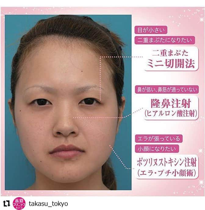 高須クリニックさんのインスタグラム写真 - (高須クリニックInstagram)「. ━･･━･･━･･━･･━･･━･･━ #Repost @takasu_tokyo ━･･━･･━･･━･･━･･━･･━ 二重まぶた・ミニ切開法+隆鼻注射（ヒアルロン酸注射）+ボツリヌストキシン注射（エラ・プチ小顔術）﻿ ﻿ 目は右が一重で左が奥二重です。﻿ 目が細く、眠たそうではっきりしない印象があります。﻿ 鼻の根元が低く、目鼻立ちがはっきりしません。﻿ 斜めから見ると、鼻の根元がくぼんでいるのがよく分かります。﻿ エラの筋肉が発達しており、正面から見ると、顔の横幅が大きく見えます。﻿ 術後1ヶ月で、目はミニ切開二重手術でそれほど幅の広くない平行型の二重にしました。﻿ 左右の目が均等に大きくなり、明るくはっきりとした印象になりました。﻿ 鼻は低かった鼻の根元にヒアルロン酸を1本弱注入し、少し高くしました。﻿ 斜めから見ると鼻筋が通ってて、上品に見えます。﻿ エラにはボツリヌストキシン注射（エラ、プチ小顔術）をして、顔の下半分の横幅を小さくしました。﻿ 正面の写真をみるとよく分かると思います。﻿ 顔が小さくなると、顔の表面積が小さくなった分、相対的に目が大きくなるので、ボツリヌストキシン注射（エラ、プチ小顔術）をすると、デカ目になった感じになります。﻿ アイラインをこれくらいしっかり引くと、二重の幅が狭くなったように見えるので、これくらい二重の幅があってよかったと思います。﻿ もっとデカ目メイクをする方は、もっと二重の幅を広げてもいいと思います。﻿ ﻿ 【🌿料金】﻿﻿﻿﻿﻿﻿﻿﻿﻿﻿﻿﻿﻿﻿﻿﻿﻿﻿﻿﻿﻿﻿﻿﻿ ● 二重まぶた・ミニ切開法（部分切開）﻿﻿﻿﻿﻿﻿ 片目¥135,000（税抜）﻿﻿﻿﻿﻿﻿﻿﻿﻿﻿﻿﻿﻿ 両目¥250,000（税抜）﻿﻿﻿﻿﻿﻿﻿﻿﻿﻿﻿﻿﻿ ※脂肪切除をする場合や埋没法の糸を抜去する場合の費用も含まれております。﻿﻿﻿﻿﻿﻿﻿﻿﻿ ﻿ ﻿● 隆鼻注射（ヒアルロン酸注射）﻿﻿﻿﻿﻿﻿ ヒアルロン酸¥50,000﻿﻿﻿﻿﻿（税抜）﻿﻿﻿﻿﻿﻿﻿﻿﻿ 長期持続型ヒアルロン酸注射シャープラインノーズ¥150,000﻿﻿﻿﻿﻿（税抜）﻿﻿﻿﻿﻿﻿﻿﻿﻿ ﻿ ●ボツリヌストキシン注射（エラ・プチ小顔術）﻿﻿ 1回¥150,000（税抜）﻿﻿ ﻿﻿﻿﻿﻿﻿﻿﻿﻿﻿﻿﻿﻿﻿﻿﻿﻿﻿ 【⚠️副作用・リスク】﻿﻿﻿﻿﻿﻿﻿﻿﻿﻿﻿﻿﻿﻿﻿﻿﻿﻿﻿﻿﻿﻿﻿﻿ ● 二重まぶた・ミニ切開法（部分切開）﻿﻿﻿﻿ まぶたの強い腫れ（術後/個人差があります）、内出血（術後）、仕上がりの左右差（片目ずつ手術をする場合）、不自然な二重（無理に二重の幅を広げた場合）、仕上がりのわずかな左右差（完璧なシンメトリーは不可）、仕上がりが完璧に自分の理想の形にならないことがある）﻿﻿﻿﻿﻿﻿﻿﻿﻿﻿﻿﻿、二重のラインの癒着がとれる可能性、手術後の血腫﻿﻿ ﻿ ● 隆鼻注射（ヒアルロン酸注射）﻿﻿﻿﻿﻿﻿ プロテーゼの輪郭が浮き出て不自然になる（サイズや形の合わないプロテーゼを入れた場合）、仕上がりのわずかな左右差（完璧なシンメトリーは不可）、仕上がりが完璧に自分の理想の形にならないことがある、感染﻿﻿﻿﻿﻿﻿ ﻿﻿ ●ボツリヌストキシン注射（エラ・プチ小顔術）﻿﻿ 内出血（注射針が血管に当たってしまった場合）、妊活・妊娠・授乳中の方への施術不可、仕上がりのわずかな左右差（完璧なシンメトリーは不可）﻿﻿﻿﻿、一時的に噛む力が弱く感じる ﻿﻿﻿﻿﻿﻿﻿﻿﻿﻿﻿﻿﻿﻿﻿﻿﻿﻿﻿﻿﻿﻿﻿﻿﻿﻿﻿﻿﻿﻿ #高須クリニック　#高須克弥　#美容　#美容整形　#整形手術　#整形　#プチ整形　#整形したい　#美容外科　#美容クリニック　#東京　#かわいい　#可愛くなりたい　#綺麗　#綺麗になりたい　#美人　#美容好きな人と繋がりたい　#美容好き　#目元　#二重　#二重まぶた　#二重術　#鼻　#隆鼻術　#注射　#フェイスライン　#輪郭　#コンビネーション　#ナチュラル」4月12日 15時13分 - takasu_staff