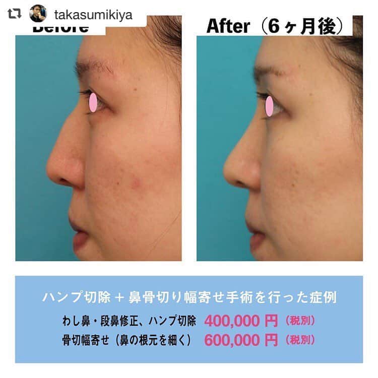 高須クリニック名古屋院さんのインスタグラム写真 - (高須クリニック名古屋院Instagram)「#repost @takasumikiya via @PhotoAroundApp  ハンプ切除＋鼻骨切り幅寄せ手術を行った症例 ・ 20代女性の患者様で、ワシ鼻を治して、綺麗に鼻筋を通す目的でカウンセリングしました。 診察させていただいたところ、ハンプ（鼻骨と軟骨の接合部の突出している部分）が発達しており、ワシ鼻になっていました。 ハンプ切除をすることになりましたが、ハンプの部分の骨が発達して、骨が横にも広がっていたので、同時に骨切り幅寄せ手術もすることになりました。 ・ 手術後はワシ鼻が改善し、横から見て、鼻根部から鼻尖までがほぼ真っ直ぐな鼻になりました。 また正面から見て鼻根部から鼻背にかけて細くなったことにより鼻筋が綺麗に通りました。 ・ ハンプが強く発達している鼻に対してハンプ切除のみを行うと、横から見て真っ直ぐになっても、鼻筋がなくなり、正面からみて鼻が太くなったように見えることがあります。 そのような鼻にはハンプ切除だけでなく、骨切り幅寄せも行うと、綺麗に鼻筋が通ります。 ・ 【料金】 ●わし鼻・段鼻修正、ハンプ切除：400,000円（税別） ●骨切幅寄せ（鼻の根元を細く）：600,000円（税別） ※料金は2019年3月4日現在 ※保険適用外、自由診療 ・ 【リスク・副作用など】 ☆わし鼻・段鼻修正、ハンプ切除 ●鼻が横に大きく広がって見える（元々鼻が横に広がっている人の場合） ☆骨切幅寄せ（鼻の根元を細く） ●鼻ギプスがマスクで隠しきれない／目や鼻周辺の腫れ（術後） ●腫れ・内出血（術後） ・ 【ご予約・お問い合わせ】 名古屋院☎︎ 052-564-1187 名古屋院📱 @takasuclinic_nagoya ↑名古屋院インスタのプロフィール画面からも直接コンタクトが取れます📲 https://www.takasu.co.jp/ ・ ・ #高須クリニック #高須クリニック名古屋院 #高須幹弥 #高須英津子 #美容整形 #整形 #二重 #埋没法 #二重切開 #ヒアルロン酸 #鼻 #ニキビ跡 #たるみ #眼瞼下垂 #シワ #ほうれい線 #整形したい #美容好きな人と繋がりたい #可愛くなりたい #綺麗になりたい #平行二重 #末広二重 #プチ整形 #二重整形 #目尻切開 #目頭切開 #ビフォーアフター」4月13日 14時46分 - takasuclinic_nagoya