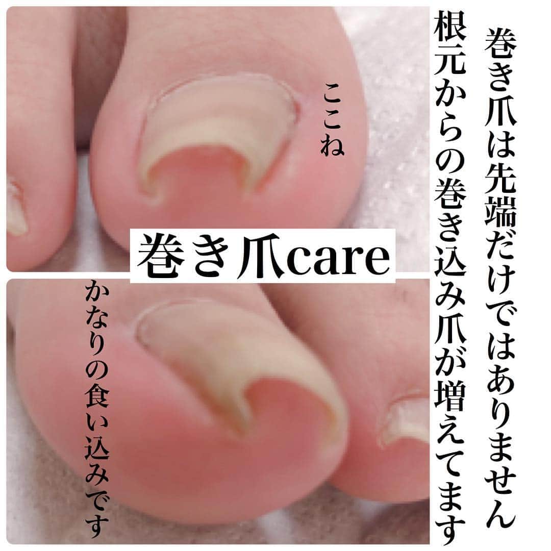 KIRAさんのインスタグラム写真 - (KIRAInstagram)「爪先の巻き爪矯正って たくさんあります  最近は根元からの痛みの相談がとても多いです  こちらは学生さんです ローファーが原因です  この靴履くなってわけにいきません 学校指定ですからね  確かにその日に広げられます でもそれでは改善しません お客様は毎日毎日生活します  足底の柔らかさ 厚み 歩き方 骨格 原因は一つだけではありません  ただ私達は毎日の生活が楽になり その生活の中で 気になることなく 改善させてあげなくては いけません  #美爪#ネイル#深爪再生二週間#ジェルネイル#ジェルアート#ジェル#ネイル#女子力#ビジュー#浮かないジェルネイル#爪育整法#深爪再生#深爪緩和#深爪再生#噛み癖#むしり癖#深爪再生セミナー#短期深爪再生#ネイリスター#ネイリスト#メディカルネイリスター#トラブルネイル＃深爪技工士#東京セミナー#大阪セミナー#ネイルケア外来#フットケア外来#巻き爪#巻き爪の痛みとれます ご質問・ご相談はDM、メール✉からお気軽にお問い合わせください😊」4月14日 11時57分 - thekirastory