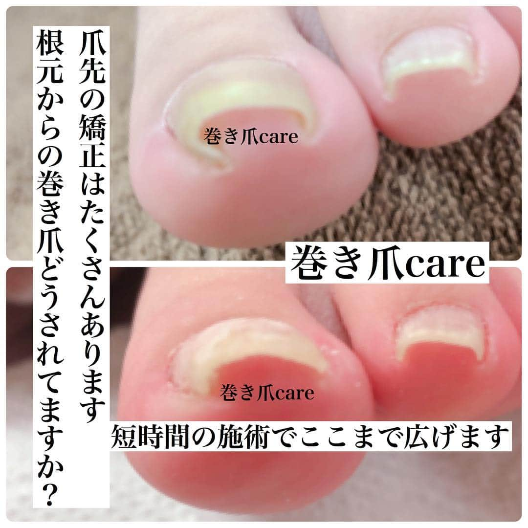 KIRAのインスタグラム：「爪先の巻き爪矯正って たくさんあります  最近は根元からの痛みの相談がとても多いです  こちらは学生さんです ローファーが原因です  この靴履くなってわけにいきません 学校指定ですからね  確かにその日に広げられます でもそれでは改善しません お客様は毎日毎日生活します  足底の柔らかさ 厚み 歩き方 骨格 原因は一つだけではありません  ただ私達は毎日の生活が楽になり その生活の中で 気になることなく 改善させてあげなくては いけません  #美爪#ネイル#深爪再生二週間#ジェルネイル#ジェルアート#ジェル#ネイル#女子力#ビジュー#浮かないジェルネイル#爪育整法#深爪再生#深爪緩和#深爪再生#噛み癖#むしり癖#深爪再生セミナー#短期深爪再生#ネイリスター#ネイリスト#メディカルネイリスター#トラブルネイル＃深爪技工士#東京セミナー#大阪セミナー#ネイルケア外来#フットケア外来#巻き爪#巻き爪の痛みとれます ご質問・ご相談はDM、メール✉からお気軽にお問い合わせください😊」