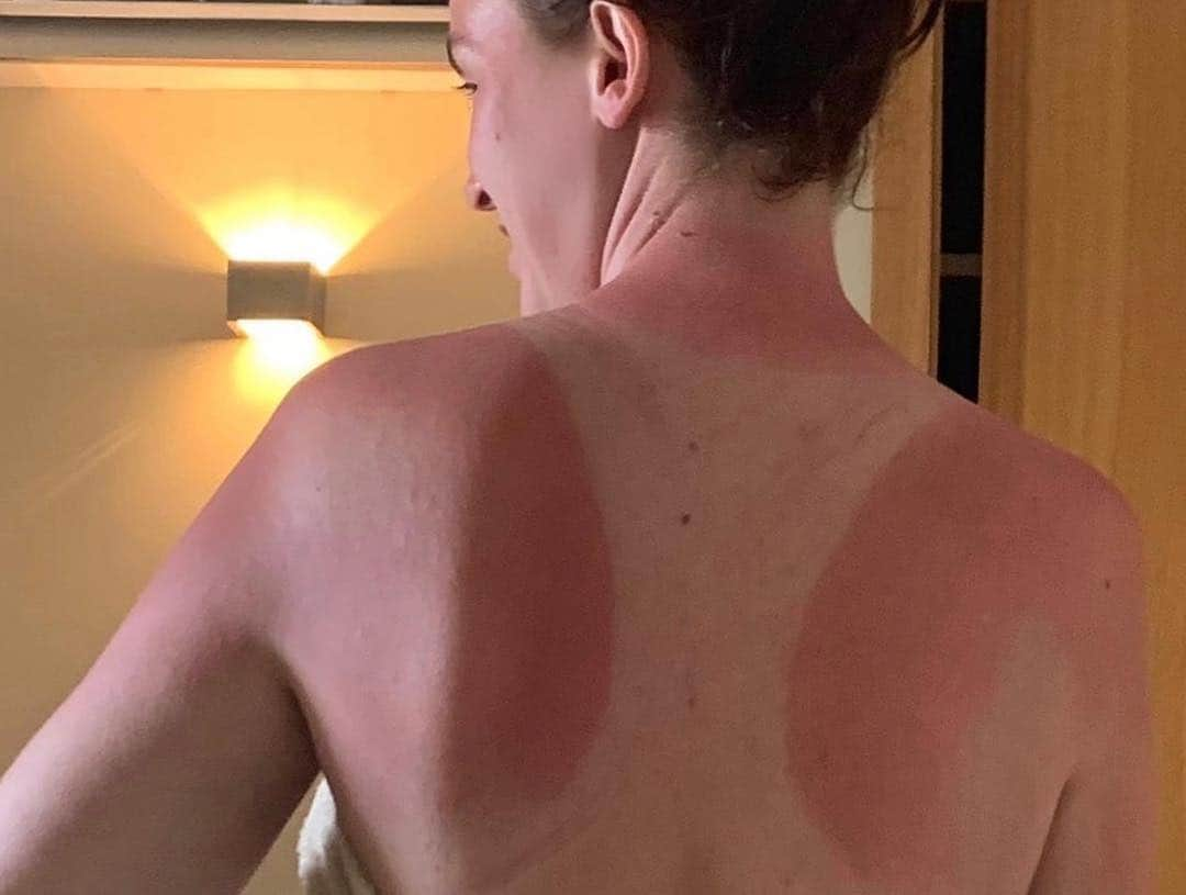 ヴィッキー・パティソンさんのインスタグラム写真 - (ヴィッキー・パティソンInstagram)「Instagram v Reality of a Brit abroad... 😂🙈😩🦞 Thought I was all smug with my sunnies and sexy swimsuit didn’t I?!! Then I go for 1 walk and underestimate the sun and LOOK WHAT HAPPENS??! I look a twat... I look like I’m still wearing my vest.. I’m the butt of every joke.. Kids, don’t be a fool, in the words of Baz Luhrmann: WEAR SUNSCREEN you tit. (I’ve paraphrased slightly 😂🙈 Swimsuit is @southbeachofficial  Burn mark was created by a lovely @asos number LOL 😂🙈」4月16日 17時14分 - vickypattison