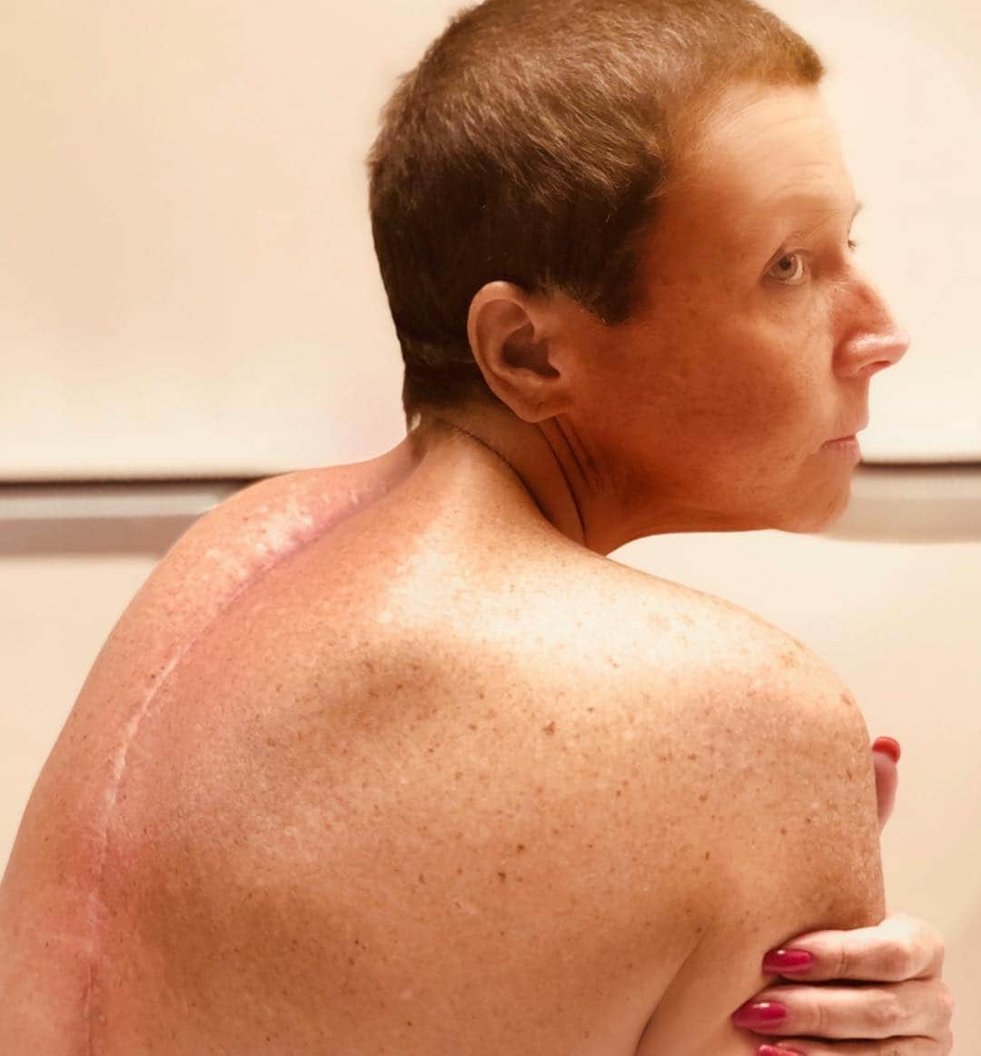 アビー・リー・ミラーさんのインスタグラム写真 - (アビー・リー・ミラーInstagram)「One year ago today ~ I underwent emergency surgery for an infection in my spine. This mass/tumor choking my spinal cord turned out to be Burkitt Lymphoma. I endured ten rounds of chemo therapy (each lasting 6 days with 4/ 24hr bags pumping poison into my body ending with a spinal tap in 3 spots, plus another shot of Chemo into my tailbone area up the spinal cord around my brain cavity) Ten times! Another spine surgery was needed & I have one more still to go. I struggled thru months of physical therapy to learn to sit up again, to crawl and maybe with a miracle someday I’ll walk. Why didn’t the ER Doctors on duty do their jobs?  I came in twice with the same symptoms? Why didn’t somebody listen to me, the patient? I finally found the right team that’s why I lived to tell my story, I have a lot to say! Thank you to all wonderful top notch professionals who continue to help me heal. For those who missed it, misdiagnosed me, and the so called  Federal “Doctor” who took me off medication cold turkey and the other ER “Doctor Hollywood” who told me to go home and take it easy for 10 days - STOP practicing! Please 🙏🏻」4月18日 2時53分 - therealabbylee