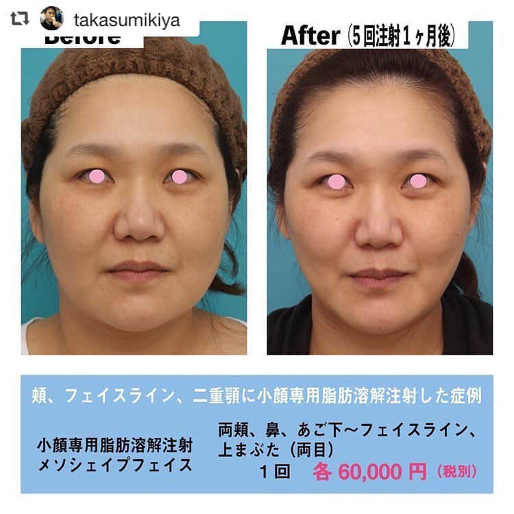 高須クリニック名古屋院さんのインスタグラム写真 - (高須クリニック名古屋院Instagram)「#repost @takasumikiya via @PhotoAroundApp  頬、フェイスライン、二重顎に小顔専用脂肪溶解注射メソシェイプフェイスをした症例 ・ 30代女性の患者様で、小顔にしたいというご要望でした。 診察させていただいたところ、顔全体、特に、頬、フェイスライン、顎下に皮下脂肪がたくさんついていました。 顎下の皮下脂肪が多く、年齢相応の顔のたるみもあったため、二重顎になっていました。 ・ 皮下脂肪の量はそれなりに多かったので、脂肪吸引の適応もありましたが、患者様は、「1週間のダウンタイムをとるのが難しく、まずは腫れが少ない小顔専用脂肪溶解注射メソシェイプフェイスでやりたい」というご希望でした。 そのため、頬～フェイスライン～顎下に小顔専用脂肪溶解注射メソシェイプフェイスを2週間以上間隔を空けて繰り返し注射していくことになりました。 ・ 回数を重ねる毎に徐々に皮下脂肪は減っていき、5回目の注射が終わった時点では一回り顔が小さくなりました。 顎下の皮下脂肪が減ったことにより、二重顎も改善しました。 ・ 【料金】 ●小顔専用脂肪溶解注射メソシェイプフェイス 両頬1回：60,000円（税別）／あご先：60,000円（税別）／あご下〜フェイスライン1回：60,000円（税別）／まぶた（両目）1回：60,000円（税別）／鼻1回：60,000円（税別） ※料金は2019年4月12日現在 ※保険適用外、自由診療 ・ 【リスク・副作用など】 ●内出血（注射針が血管に当たってしまった場合） ●アレルギー症状（パイナップルアレルギーの方） ・ 【ご予約・お問い合わせ】 名古屋院☎︎ 052-564-1187 名古屋院📱 @takasuclinic_nagoya ↑名古屋院インスタのプロフィール画面からも直接コンタクトが取れます📲 https://www.takasu.co.jp/ ・ ・ #高須クリニック #高須クリニック名古屋院 #高須幹弥 #高須英津子 #美容整形 #整形 #二重 #埋没法 #二重切開 #ヒアルロン酸 #鼻 #たるみ #眼瞼下垂 #シワ #ほうれい線 #毛穴 #目 #整形したい #美容好きな人と繋がりたい #可愛くなりたい #綺麗になりたい #平行二重 #末広二重 #プチ整形 #二重整形 #目尻切開 #目頭切開 #ビフォーアフター」4月18日 9時52分 - takasuclinic_nagoya