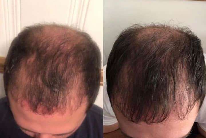 CosmoProf Beautyさんのインスタグラム写真 - (CosmoProf BeautyInstagram)「The right products make a🌎of difference👏 ✨ This #BeforeAndAfterHair was achieved using @ACTiiV Recover Thickening Cleansing Treatment for Men. ✨ Unlock healthy hair secrets with ACTiiv at #cosmoprofbeauty where you are #licensedtocreate . . . . #repost #actiiv #actiivhairscience #hairtransformation #hairmakeover #mensgrooming #menshairstyles #guyshair #balding」4月20日 23時00分 - cosmoprofbeauty