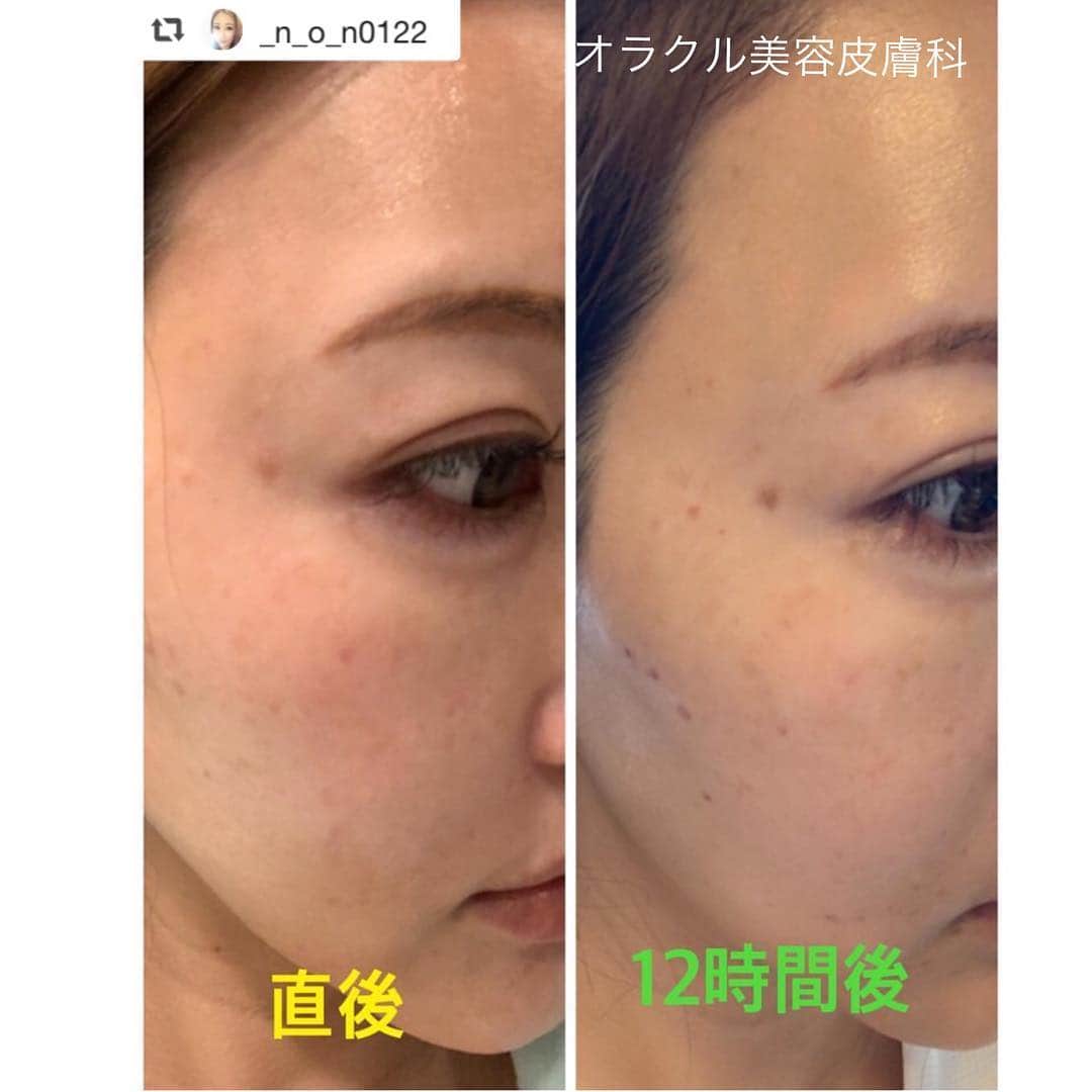 オラクル美容皮膚科東京新宿院さんのインスタグラム写真 - (オラクル美容皮膚科東京新宿院Instagram)「. 大人気シミ治療#ルメッカ の経過を アップしていただきました✨ . もともと薄いシミが多く従来のIPLで 反応させることは難しかった症例です🙄❗️ . 最新のIPL#ルメッカ ならここまで 反応させることが可能です😭💕 . GWは是非ルメッカでシミ取りされては いかがでしょうか❓ . お早めのご予約をお待ちしております🙇‍♀️ . . ☆・‥…━━━☆・‥…━━━☆ . 【オラクル美容皮膚科】 https://www.oracleclinic.jp/ フリーダイヤル ☎0120-905-696 コールセンター 受付時間 9:00～21:00［年中無休］ LINEからもご予約可能です ID：@oracle.jp . ☆・‥…━━━☆・‥…━━━☆ . . . #オラクル美容皮膚科 #オラクル  #oracle #韓国美容 #美容皮膚科  #IPL #くすみ #赤ら顔 #アンチエイジング . . . #repost @_n_o_n0122 via @PhotoAroundApp  最新シミとりフォト 『ルメッカ』やってみた💗  直後⇨少し赤みとヒリヒリ 12時間後⇨今まで見えてなかったところも黒く浮いてくる 2〜６日後⇨点々と黒くなったまま。日中はコンシーラーで、隠す。 6〜７日後⇨浮いてるシミがポロっと剥がれる、黒い点々がなくなって綺麗になる  １回でもかなり実感✨ まだまだとれそうなので来月もします🎶  #シミ取り  #ルメッカ#フォトフェイシャル #オラクル美容皮膚科」4月22日 9時06分 - oraclejp