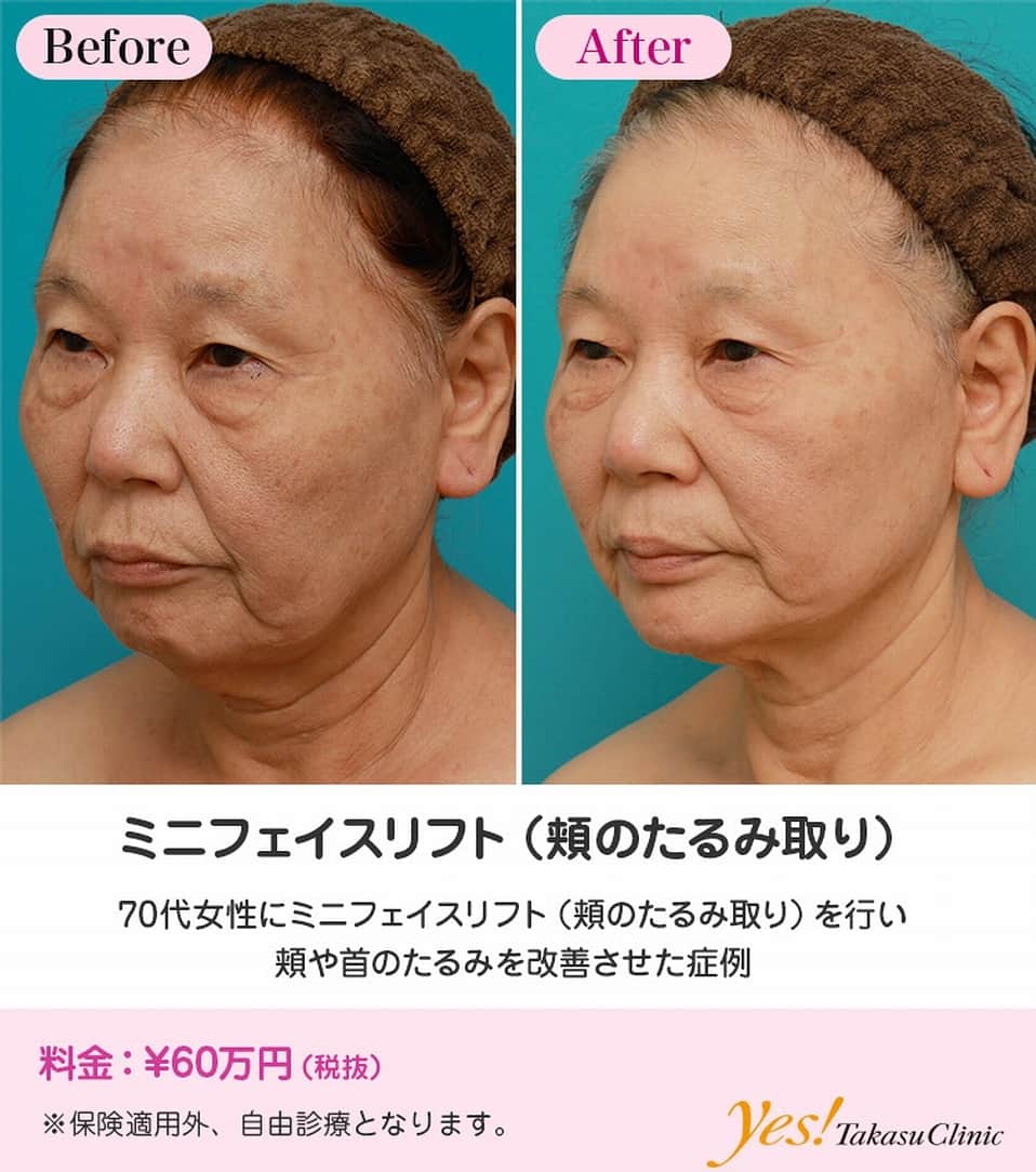 高須クリニックさんのインスタグラム写真 - (高須クリニックInstagram)「⠀ 👨🏻‍⚕️高須幹弥医師からのコメント✨⠀ 70代半ばの女性で、エイジングケア希望で来院されました。 診察させていただいたところ、年齢相応に顔全体がたるんでおり、特に、上まぶた、下まぶた、頬~フェイスライン~首にかけてたるんでいました。 患者様は、頬~フェイスライン~首のたるみを改善させたいというご要望でした。 年齢相応にかなりのたるみがあったので、当院の治療の中で、最も効果の大きいフルフェイスリフトをご検討いただきましたが、そんなに大掛かりな手術ではなく、少したるみが改善すればいいということでしたので、ミニフェイスリフト（頬のたるみ取り）をすることになりました。 こめかみの頭髪内から耳前部にかけて小さな切開をし、ザイゴマティックリガメントを皮下で外した後、SMAS三角弁を作り、ミニフェイスリフト（頬のたるみ取り）の範囲内でできる限り引っ張りました。 術後は、ミニフェイスリフト（頬のたるみ取り）なりに、頬~フェイスライン~首にかけてリフトアップされ、目立っていた顔の下半分をほどよくエイジングケアすることができました。 頬~フェイスライン~首のたるみの切るリフトアップ手術は、ミニフェイスリフト（頬のたるみ取り）~ミディアムフェイスリフト~フルフェイスリフトの3段階あります。 患者様の顔のたるみ具合、どれだけリフトアップするかのご希望、予算などに応じて、カウンセリングでしっかりと話し合い、臨機応変に決めさせていただきます。 ----------------------------------------------------⠀ 🌈料金✨⠀ ●ミニフェイスリフト（頬のたるみ取り） ¥600,000 【東京 、横浜 、名古屋 、大阪 】⠀ ----------------------------------------------------⠀ ⚠️リスク・副作用・合併症✨⠀ ●ミニフェイスリフト（頬のたるみ取り） 切開した周辺の腫れ（術後） 仕上がりのわずかな左右差（完璧なシンメトリーは不可） 傷跡が肥厚性瘢痕やケロイドになる可能性 感覚が鈍くなる可能性 手術後の血腫⠀ ---------------------------------------------------⠀ 😊施術についての詳細✨⠀ https://www.takasu.co.jp/photo/minilift21.html ----------------------------------------------------⠀ 📞ご予約・お問い合わせ✨⠀ 0120-5587-10⠀ https://www.takasu.co.jp/cgi-bin/form/contact.cgi⠀ ----------------------------------------------------⠀ #顔のしわ #顔のたるみ #顔のシワ #頬のたるみ #フェイスライン #首のたるみ#ミニフェイスリフト #頬のたるみ改善 #たるみ改善 #皮膚 #美容 #美肌 #アンチエイジング #美容整形 #美容外科 #美容クリニック #美容好き #美容皮膚科 #モニター #モニター募集  #高須クリニック #高須クリニック名古屋 #高須幹弥 #整形したい #プチ整形 #症例 #症例写真 #可愛くなりたい #可愛い #美人」4月23日 17時12分 - takasu_staff