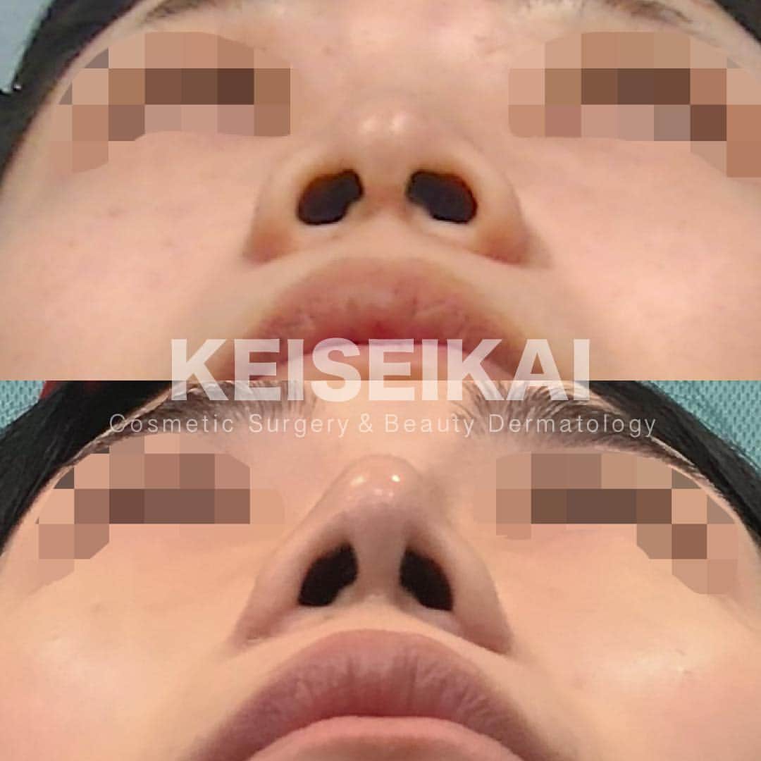 恵聖会クリニックさんのインスタグラム写真 - (恵聖会クリニックInstagram)「⠀ ＼美鼻モニター様／ ⠀ 鼻のヒアルロン酸で高さを出されていたモニター様。 シュッとした鼻になりたい！ と希望され ▫️鼻プロテーゼ I型 ▫️鼻尖形成 ▫️小鼻縮小 中間法 を受けられました。 ⠀ カウンセリングは無料で行っております。 鼻の手術を希望される方は、どの様な鼻になりたいか教えてください。適切な治療をご案内させていただきます。 ⠀ 1枚目→左：施術前  右：施術3ヶ月後 2枚目→上：施術前  下：施術3ヶ月後 ⠀ 💴鼻プロテーゼ：150,000円 💴鼻尖形成：250,000円 💴小鼻縮小 中間法：180,000円 計580,000円 ※税抜表示 ⠀ ⚠️リスク：腫れ・浮腫・内出血・感染症・血腫 ⠀ #美鼻 #鼻整形 #プロテーゼ #鼻プロテーゼ #隆鼻術 #鼻を高く #鼻を高くしたい #鼻尖形成 #小鼻縮小 #鼻翼縮小 #団子鼻 #だんご鼻 #整形 #美容整形 #ビフォーアフター #症例写真 #恵聖モニター #恵聖会クリニック #美容外科 #美容クリニック #大阪 #心斎橋 #京橋」4月23日 18時08分 - keiseikai