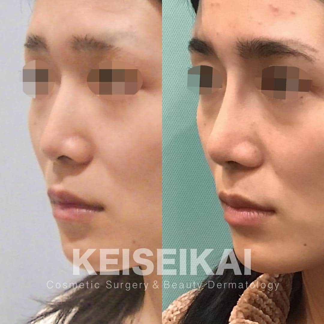 恵聖会クリニックさんのインスタグラム写真 - (恵聖会クリニックInstagram)「⠀ ＼美鼻モニター様／ ⠀ 鼻のヒアルロン酸で高さを出されていたモニター様。 シュッとした鼻になりたい！ と希望され ▫️鼻プロテーゼ I型 ▫️鼻尖形成 ▫️小鼻縮小 中間法 を受けられました。 ⠀ カウンセリングは無料で行っております。 鼻の手術を希望される方は、どの様な鼻になりたいか教えてください。適切な治療をご案内させていただきます。 ⠀ 1枚目→左：施術前  右：施術3ヶ月後 2枚目→上：施術前  下：施術3ヶ月後 ⠀ 💴鼻プロテーゼ：150,000円 💴鼻尖形成：250,000円 💴小鼻縮小 中間法：180,000円 計580,000円 ※税抜表示 ⠀ ⚠️リスク：腫れ・浮腫・内出血・感染症・血腫 ⠀ #美鼻 #鼻整形 #プロテーゼ #鼻プロテーゼ #隆鼻術 #鼻を高く #鼻を高くしたい #鼻尖形成 #小鼻縮小 #鼻翼縮小 #団子鼻 #だんご鼻 #整形 #美容整形 #ビフォーアフター #症例写真 #恵聖モニター #恵聖会クリニック #美容外科 #美容クリニック #大阪 #心斎橋 #京橋」4月23日 18時08分 - keiseikai