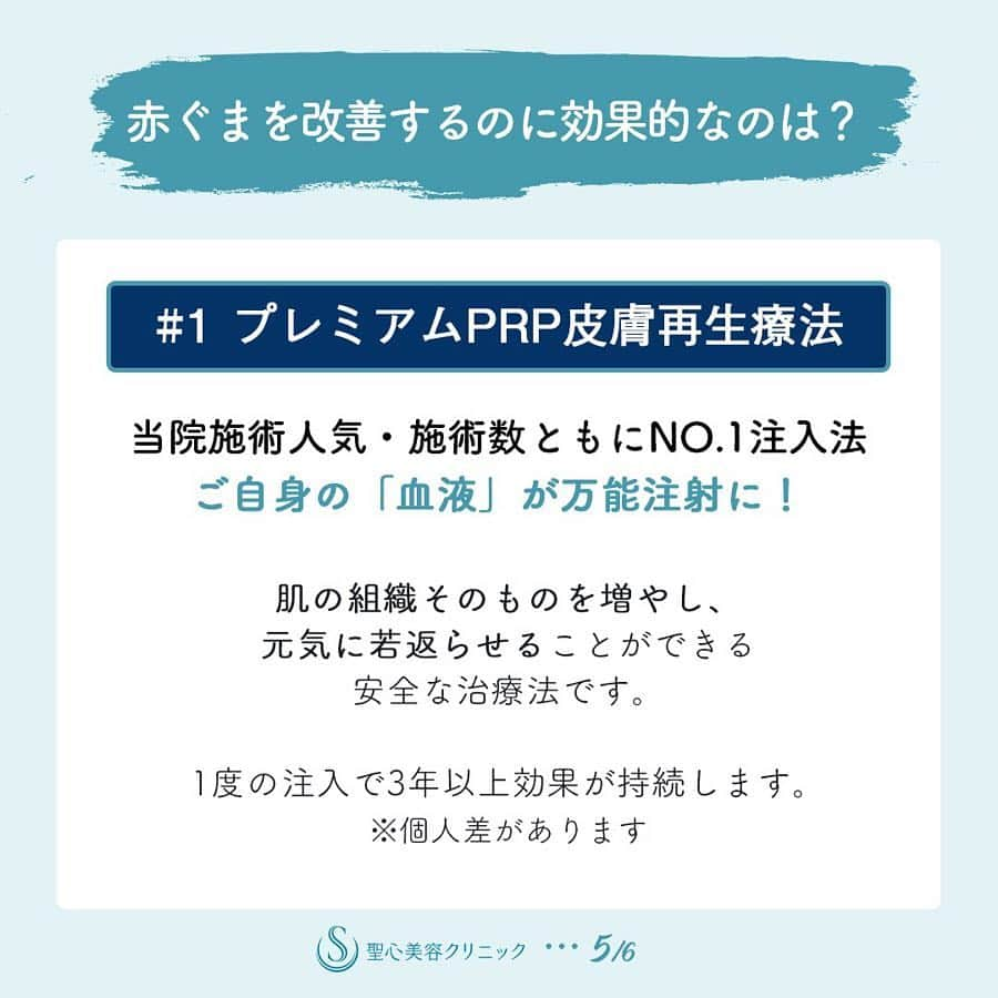 聖心美容クリニック公式アカウント さんのインスタグラム写真 - (聖心美容クリニック公式アカウント Instagram)「#聖心美容コラム  目の下のくまのタイプ別原因、赤ぐま編。 . 一般的なくまとは違い、目の下の脂肪が浮き出ることによってできる影がくまのように見える状態。 その原因は脂肪のたるみ😣？！ 詳しくは投稿画像をswipeしてみてください♡ _ #目の下のたるみ #目の下のクマ #たるみ改善 #美容女子 _ #コスメ好きさんと繋がりたい #コスメマニア #美容垢さんと繋がりたい #美意識高い人と繋がりたい #美容好きな人と繋がりたい #美意識向上 #美容好き #美活 #きれいになりたい #可愛くなりたい #綺麗になる #自分磨き #微整形 #プチ整形 #整形したい #整形 #美魔女 #ドクターズコスメ #肌質改善 #美容外科 #美容皮膚科 #美容マニア  _ #美容クリニック #聖心美容クリニック #seishinbiyou」4月24日 21時02分 - seishinbiyou