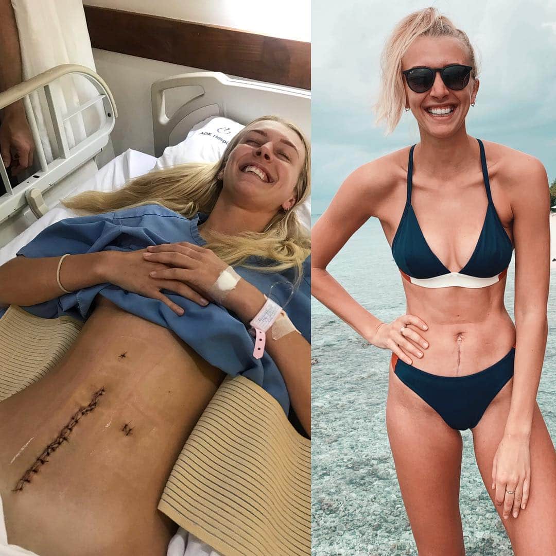 Zanna Van Dijkさんのインスタグラム写真 - (Zanna Van DijkInstagram)「It’s crazy to think these two photos were both taken in the Maldives! 😱 I am now officially three months post emergency bowel surgery and I’m feeling strong 💪🏼 I have bounced back at an astonishing rate. My surgeon initially said it would be three months until I even started gently exercising. In reality my body was ready to start rehab exercises 5 weeks post op. And now at the 3 month mark? I’m pretty much back to my previous strength, which is crazy! 🥳 In terms of rehab, now I am just doing clinical pilates at @complete_pilates to strengthen my core and also scar rehab and manipulation with @lvb_physio👌🏼 I have to thank my pre-surgery self for living such a healthy lifestyle as that is what set me up for a successful recovery. And my post-surgery self for remaining positive and proactive. Honestly, it is incredible what your body does for you when you treat it with love and respect. I hope that my journey inspires you to build a strong and resilient body which can bounce back from anything life throws at you ❤️ #cecalvolvulus #bowelsurgery #operationcomeback」4月26日 17時13分 - zannavandijk