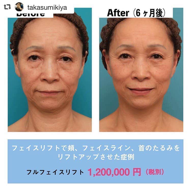 高須クリニック名古屋院さんのインスタグラム写真 高須クリニック名古屋院instagram Repost Takasumikiya Via Photoaroundapp フェイスリフトで頬 フェイスライン 首のたるみをリフトアップさせた症例 70代女性の患者様です 60代のときにミニリフトを受け