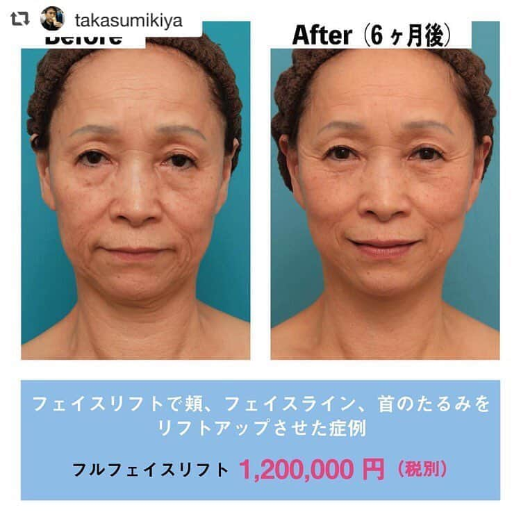 高須クリニック名古屋院さんのインスタグラム写真 - (高須クリニック名古屋院Instagram)「#repost @takasumikiya via @PhotoAroundApp  フェイスリフトで頬、フェイスライン、首のたるみをリフトアップさせた症例 ・ 70代女性の患者様です。 60代のときにミニリフトを受けています。ミニリフトのときに上がりきらなかった顎下や首のたるみが目立っています。 ミニリフトの効果は半永久的に持続するのですが、ミニリフト後にある程度老化は進行しており、頬やフェイスラインのたるみも目立っています。 ・ 今回はフルフェイスリフトを行い、頬、フェイスライン。顎下、首のたるみをまとめてリフトアップすることになりました。 手術は局所麻酔下に行い、前回のミニリフトの傷跡を延長して切開し、SMASと広頸筋（プラティスマ）の下を剥離し、SMASと広頸筋を引き上げ固定し、余分な皮膚を切除した後皮膚縫合しました。 ・ 手術後は、頬、フェイスライン、顎下、首のたるみが改善し、顔の下半分が全体的に若返りました。 ・ 【料金】 ●フルフェイスリフト 頬・アゴ：1,200,000円（税別） ※料金は2019年4月1日現在 ※保険適用外、自由診療 ・ 【リスク・副作用など】 ●切開した周辺の腫れ（術後） ●仕上がりの左右差（完璧なシンメトリーは不可） ●傷跡が肥厚性瘢痕やケロイドになる可能性 ●感覚が鈍くなる可能性 ●手術後の血腫 ・ 【ご予約・お問い合わせ】 名古屋院☎︎ 052-564-1187 名古屋院📱 @takasuclinic_nagoya ↑名古屋院インスタのプロフィール画面からも直接コンタクトが取れます📲 https://www.takasu.co.jp/ ・ ・ #高須クリニック #高須クリニック名古屋院 #高須幹弥 #高須英津子 #美容整形 #整形 #二重 #埋没法 #二重切開 #ヒアルロン酸 #鼻 #ニキビ #ニキビ跡 #たるみ #眼瞼下垂 #シワ #ほうれい線 #毛穴 #目 #整形したい #美容好きな人と繋がりたい #可愛くなりたい #綺麗になりたい #プチ整形 #二重整形 #目尻切開 #目頭切開 #ビフォーアフター」4月27日 18時49分 - takasuclinic_nagoya