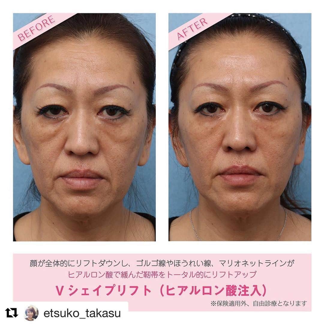 高須クリニック栄院さんのインスタグラム写真 - (高須クリニック栄院Instagram)「#Repost @etsuko_takasu with @get_repost ・・・ 50代の女性の方です。 ヒアルロン酸注射でリフトアップさせるように、頬の緩んだ靭帯を持ち上げるように、ヒアルロン酸を7本注射していきます。 ・ たるんだミッドチークを持ち上げるように注射していくと、法令線も自然と浅くなっています。 目の下のゴルゴ線はまだ残ってはいますが、ヒアルロン酸の注入量に比例しますので、もう少し追加して注入しても良いかと思います。 ・ ただ、笑うと自然に頬が上がるので、入れ過ぎると“まん丸な頬”になって、不自然になる事もありますので、必ず治療中に笑ってもらって、自然なバランスになるように心がけています。 ・ 【料金】 Vシェイプリフト（ヒアルロン酸注入）1本：100,000円（税別） ※この方の場合、モニター価格50%OFF ※2019年5月4日現在の値段 ※保険適用外、自由診療 ・ 【リスク・副作用など】 ●内出血（注射針が血管に当たってしまった場合） ●麻酔やヒアルロン酸によるアレルギー症状 ●血管の圧迫による影響 ・ 【ご予約・お問い合わせ】 名古屋院☎︎ 052-564-1187 栄院☎︎ 052-971-6650 名古屋院📱 @takasuclinic_nagoya 栄院📱 @takasuclinic_sakae ↑両院インスタのプロフィール画面からも直接コンタクトが取れます📲 https://www.takasu.co.jp/ ・ ・ #高須クリニック #高須クリニック名古屋院 #高須幹弥 #高須英津子 #美容整形 #整形 #二重 #埋没法 #二重切開 #ヒアルロン酸 #鼻 #ニキビ #ボトックス注射 #たるみ #眼瞼下垂 #シワ #ほうれい線 #毛穴 #目 #整形したい #美容好きな人と繋がりたい #可愛くなりたい #綺麗になりたい #平行二重 #プチ整形 #二重整形 #目尻切開 #目頭切開」5月25日 22時45分 - takasuclinic_sakae