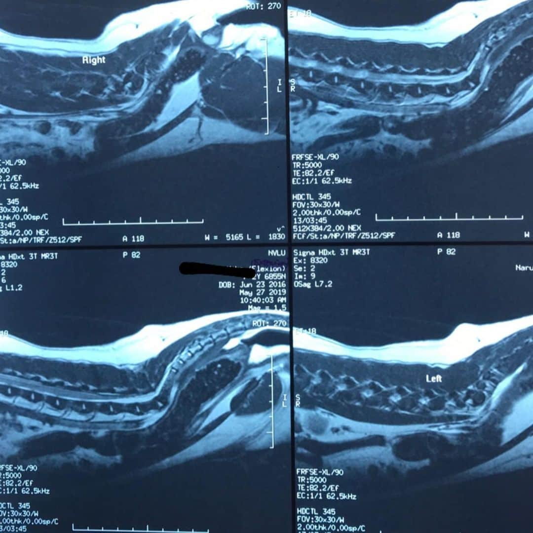 豆柴にこちゃんさんのインスタグラム写真 - (豆柴にこちゃんInstagram)「🐶🏥 ※MRIとCT写真あり。 苦手な人はスライドしないでね . #にこの右足闘病記 . 検査から無事帰還しました✨ . 今回の検査はこれから パテラ手術するにあたり、 . ●脊椎障害の有無 ●大腿骨、脛骨の変形の有無 . を調べるためにMRIとCTをとりました。 ※検査代11万😱 . これらがパテラに起因してたりすると 手術法も変わるらしく。 . 結果、にこは異常なしでした❣️ なので一般的なパテラの手術でよいそうです。 . ただ、腰の可動領域が広いようで 今は異常ないけど追々腰回りの病気になる 可能性があるらしい💦 ヘルニアとか、尿疾患とか。 予防のしようがなく、 太らないように気をつけてくださいとのこと。 . そして、 入院は6/11、手術が6/12で入院期間は約２週間、 手術は左右同時にやるそうです。 ※手術入院費60ー70万😱 にこは体小さいから安い方みたい . 残念ながらにこの誕生日6/23は 病院で一人で過ごすことに😭苦笑 . まあ仕方ないね！ . にこの手術内容は以下2点です。 ●滑車溝再建 →膝の溝を深くする . ●脛骨粗面転移術 →位置が高すぎる膝のお皿の位置を下げる . あと、前回私の認識が間違ってたのですが 右足の痛みは靭帯の部分断裂ではなく、 膝の前十字靭帯の変性、というものでした。 . パテラで骨の噛み合わせが悪いせいで、 前十字靭帯が変な収縮を繰り返し、 切れてはいないけどゆるんで腫れて痛いみたいな。 . これは治らないみたいです💦 なので切れてしまう可能性もあるけど、 パテラの手術すれば変な収縮はしにくくなるので 今より悪化は防げるらしい。 . 1ー3枚目は麻酔から覚めたにこ。 目の下クマができてゲッソリしてる😮 と思ったら、目が乾かないような液を 目に入れてたらしくそれが付着してるとのことでした😆 . ひとまず、よくがんばりました❣️ . 長文失礼しました . #柴犬#豆柴#pecoいぬ部#犬#わんこ#犬#ここ柴部#shibainu#dog#mameshiba#pecotv#dog#いぬのきもち部#しばいぬ#しばけん#こいぬ#シバイヌ#いぬ#イヌ#赤柴#マメシバ#ペット#日本犬#子犬#puppy#doggo#pet」5月27日 16時03分 - nikochan.mame48