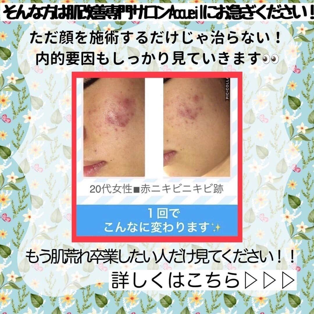 肌質改善専門サロン~Accueil~さんのインスタグラム写真 - (肌質改善専門サロン~Accueil~Instagram)「💙💚❤️5/5空きあり💛💜❤ * * 【ご予約はこちら👇🏼】 🌟🌟 @accueil_ikebukuro 🌟🌟 . ※今だけ期間限定クーポンあり . . . 肌荒れの原因は人それぞれなのにも関わらず、 周りの人と同じケアをしていませんか💦？？ * ❌お薬を塗っても飲んでも変わらない、、 ❌食事を気にしても肌が荒れる、、 ❌スキンケアを変えてもイマイチ、、 ❌何かしら常にトラブルが肌にある、、 ❌ニキビが繰り返しできる、、 * * そのお悩み解決できちゃいます😌✨ Accueilは、どのサロンに行っても良くならなかったお客さまたちや、 どの皮膚科に行っても変化がなかったお客さまたちが多く訪れてくださっています🙌💕* * * * もう悩まない！！！ 繰り返さないところまでしっかりと根本改善していきます☺️ そろそろ肌荒れから卒業しませんか？ * →→→初回体験はこちらから👉🏼 @accueil_ikebukuro * * * * Accueilでのお手当は、、 * 機械は一切使いません🙅‍♀️❌ 使うお化粧品は １００％天然の「ミネルヴァ化粧品」🌲🍃 ニキビの炎症がある方・アトピーの方でも 安心して受けていただける事ができる お肌にとても優しいエステです♡♡ * * お肌のお悩みなら、何でもお任せください😊💕 * * ■「インスタ見ました！」 で、 初回体験￥26,000 →→✨￥５，９８０✨ * * * --------当サロンのご予約方法≫--------- *  1️⃣当サロンのインスタTopのURL ⭐『Hotpepper Beauty』の 「instagram限定クーポン」にてご予約可能♡♡ * * 2️⃣インスタのDMからご予約 （下記項目を記載の上、お問い合わせください♪） * 🔶お名前（フルネーム） * 🔶お電話番号 * 🔶希望日時（第１～第３希望） * 🔶ご希望のメニュー * * 3️⃣お電話でのご予約✨ 　03-6912-5705にお願いします♡ ----------------------------------------- * * @accueil_ikebukuro ✨ #ニキビ #ニキビ跡 #毛穴 #乾燥肌 #ニキビ跡ケア #肌荒れ #ニキビ跡改善 #ニキビ肌改善 #ニキビ治療 #保湿 #毛穴の黒ずみ #毛穴の開き #スキンケア #毛穴吸引 #アトピー女子 #ニキビ皮膚科  #美肌ケア  #ニキビ専門 #肌質改善 #背中ニキビ #アトピー肌 #乾燥 #ニキビケア #毛穴ケア #アトピー治療 #肌悩み #スキンケア難民 #肌トラブル改善 #スキンケア大事 #目指せ美肌」5月5日 0時18分 - accueil_ikebukuro