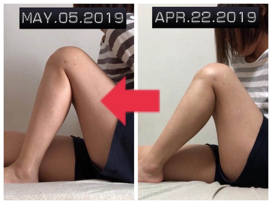 興梠友理さんのインスタグラム写真 - (興梠友理Instagram)「【術後53日目 / 53 days after surgery】 I was struggling a bit on flexion, but finally got to 130 degrees👍 ・ やっと130度まで曲がったー‼️🤣 (リハビリメニューこなした後の一番柔らかい状態で手で足を引き寄せてだけど) ・ うちの病院の前十字靭帯再建後のリハビリプロトコルでは、術後8週の目標が130度で、私は複数再建だから遅れても問題ないとは言われてたけど、やっぱり目標達成できると嬉しい✨(あと3日で満8週だったから) ・ 階段も、登る方はエスカレーターの高い段差も勢いつけずに登れるようになったから、ぼちぼち降りる方も低い段差から練習し始めました😤 ・ 次回の診察(21日)で装具を外す許可は出るかなー？🤔 ・ #努力は絶対裏切らない #ろぎ子の復活までの記録 #膝脱臼 #複合靭帯損傷 #前十字靭帯断裂 (ACL) #後十字靭帯断裂 (PCL) #内側側副靱帯断裂 (MCL) #内側膝蓋大腿靭帯断裂 (MPFL)  #前十字靭帯再建 #後十字靭帯再建 #半月板縫合 #半月板部分切除 #nevergiveup #roadtorecovery #kneeinjury #kneeinjuryrecovery #kneeinjuryrehab #multipleligamenttears #aclrecovery」5月5日 20時36分 - yuri_rogi