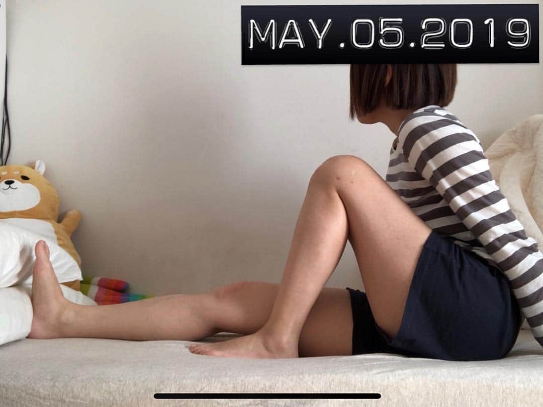のインスタグラム：「【術後53日目 / 53 days after surgery】 I was struggling a bit on flexion, but finally got to 130 degrees👍 ・ やっと130度まで曲がったー‼️🤣 (リハビリメニューこなした後の一番柔らかい状態で手で足を引き寄せてだけど) ・ うちの病院の前十字靭帯再建後のリハビリプロトコルでは、術後8週の目標が130度で、私は複数再建だから遅れても問題ないとは言われてたけど、やっぱり目標達成できると嬉しい✨(あと3日で満8週だったから) ・ 階段も、登る方はエスカレーターの高い段差も勢いつけずに登れるようになったから、ぼちぼち降りる方も低い段差から練習し始めました😤 ・ 次回の診察(21日)で装具を外す許可は出るかなー？🤔 ・ #努力は絶対裏切らない #ろぎ子の復活までの記録 #膝脱臼 #複合靭帯損傷 #前十字靭帯断裂 (ACL) #後十字靭帯断裂 (PCL) #内側側副靱帯断裂 (MCL) #内側膝蓋大腿靭帯断裂 (MPFL)  #前十字靭帯再建 #後十字靭帯再建 #半月板縫合 #半月板部分切除 #nevergiveup #roadtorecovery #kneeinjury #kneeinjuryrecovery #kneeinjuryrehab #multipleligamenttears #aclrecovery」