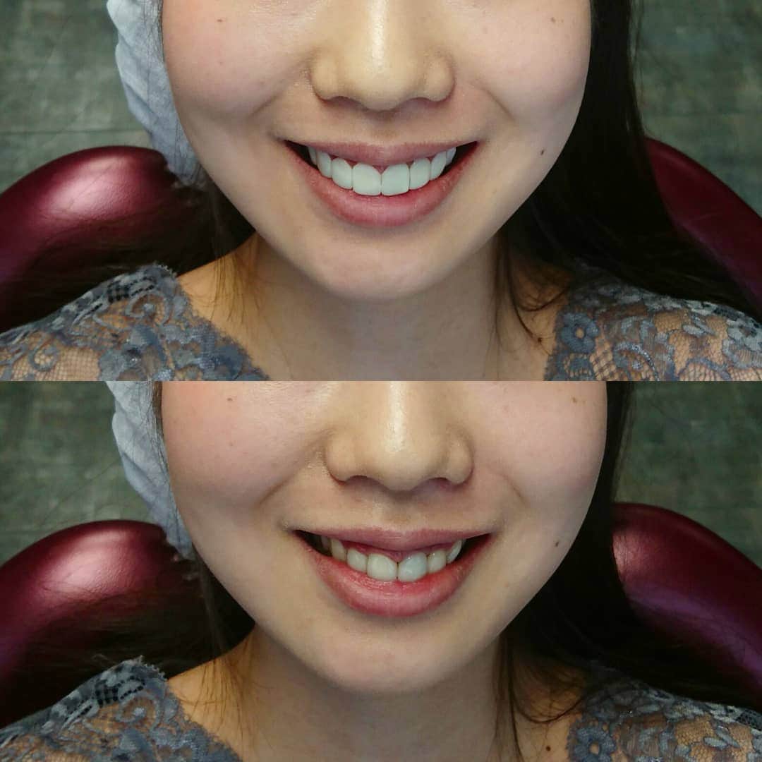 のインスタグラム：「シミュレーション❗  レジンを使ってその場10分くらいで 上の歯を作ります 歯は全くけずりませんから 写真を撮って見積もりを作ったら 元の歯に戻してしまいます  シミュレーション 2160円(期間限定)  令和記念スペシャルサービスとして  シミュレーションされて 見積もりを作られたその日に  全額をデンタルローンで申し込みされるか、 見積もり金額の半額以上をお支払される方は 総料金の10%オフになります  仮に100万円なら90万円になりますよ☺  かなり予約が先になってきてますから お早めにどうぞ☺」