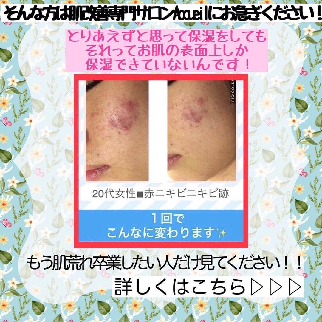 肌質改善専門サロン~Accueil~さんのインスタグラム写真 - (肌質改善専門サロン~Accueil~Instagram)「💙💚❤️5/7空きあり💛💜❤ * * 【ご予約はこちら👇🏼】 🌟🌟 @accueil_ikebukuro 🌟🌟 . ※今だけ期間限定クーポンあり . . . 肌荒れの原因は人それぞれなのにも関わらず、 周りの人と同じケアをしていませんか💦？？ * ❌お薬を塗っても飲んでも変わらない、、 ❌食事を気にしても肌が荒れる、、 ❌スキンケアを変えてもイマイチ、、 ❌何かしら常にトラブルが肌にある、、 ❌ニキビが繰り返しできる、、 * * そのお悩み解決できちゃいます😌✨ Accueilは、どのサロンに行っても良くならなかったお客さまたちや、 どの皮膚科に行っても変化がなかったお客さまたちが多く訪れてくださっています🙌💕* * * * もう悩まない！！！ 繰り返さないところまでしっかりと根本改善していきます☺️ そろそろ肌荒れから卒業しませんか？ * →→→初回体験はこちらから👉🏼 @accueil_ikebukuro * * * * Accueilでのお手当は、、 * 機械は一切使いません🙅‍♀️❌ 使うお化粧品は １００％天然の「ミネルヴァ化粧品」🌲🍃 ニキビの炎症がある方・アトピーの方でも 安心して受けていただける事ができる お肌にとても優しいエステです♡♡ * * お肌のお悩みなら、何でもお任せください😊💕 * * ■「インスタ見ました！」 で、 初回体験￥26,000 →→✨￥５，９８０✨ * * * --------当サロンのご予約方法≫--------- *  1️⃣当サロンのインスタTopのURL ⭐『Hotpepper Beauty』の 「instagram限定クーポン」にてご予約可能♡♡ * * 2️⃣インスタのDMからご予約 （下記項目を記載の上、お問い合わせください♪） * 🔶お名前（フルネーム） * 🔶お電話番号 * 🔶希望日時（第１～第３希望） * 🔶ご希望のメニュー * * 3️⃣お電話でのご予約✨ 　03-6912-5705にお願いします♡ ----------------------------------------- * * @accueil_ikebukuro ✨ #ニキビ #ニキビ跡 #毛穴 #乾燥肌 #ニキビ跡ケア #肌荒れ #ニキビ跡改善 #ニキビ肌改善 #ニキビ治療 #保湿 #毛穴の黒ずみ #毛穴の開き #スキンケア #毛穴吸引 #アトピー女子 #ニキビ皮膚科  #美肌ケア  #ニキビ専門 #肌質改善 #背中ニキビ #アトピー肌 #乾燥 #ニキビケア #毛穴ケア #アトピー治療 #肌悩み #スキンケア難民 #肌トラブル改善 #スキンケア大事 #目指せ美肌」5月7日 13時00分 - accueil_ikebukuro