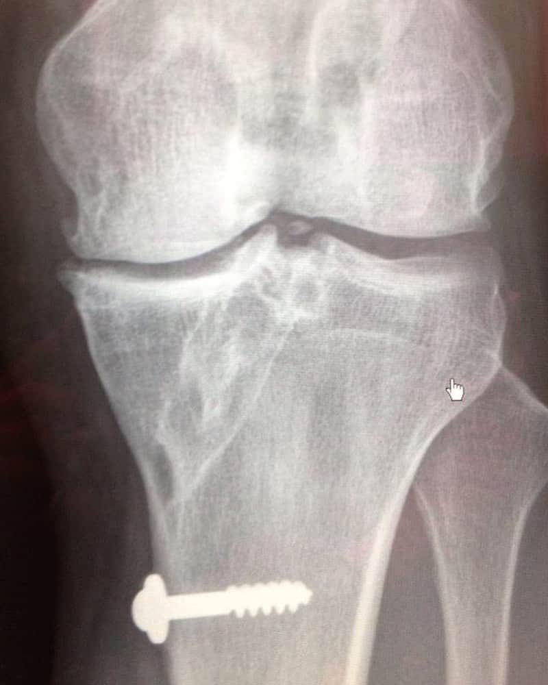 陳建州さんのインスタグラム写真 - (陳建州Instagram)「我的膝蓋⋯⋯有紀念品！🤣🤣🤣」5月9日 15時42分 - blackielovelife