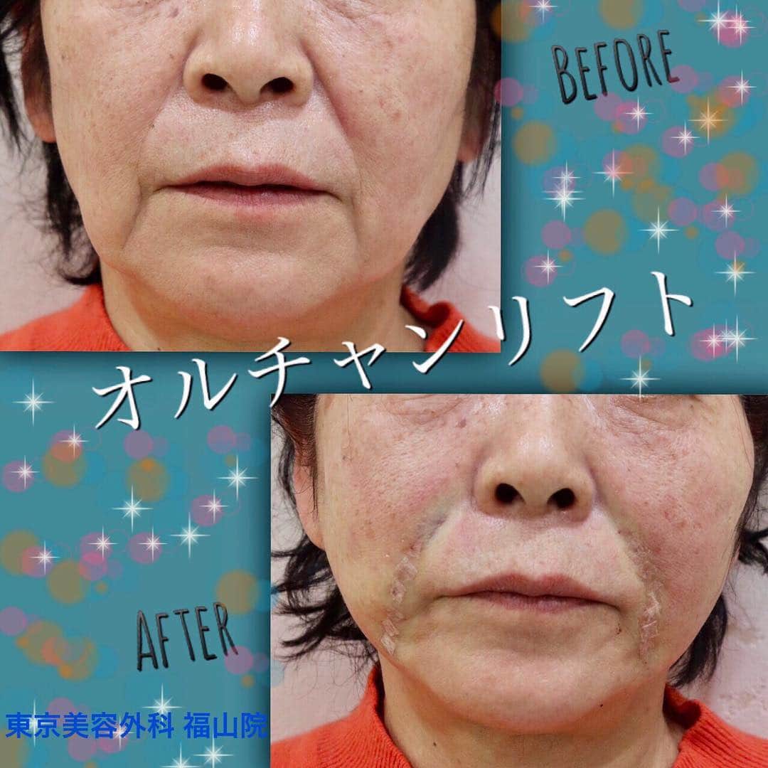 東京美容外科公式さんのインスタグラム写真 - (東京美容外科公式Instagram)「🌷東京美容外科福山院です🌷 本日は大人気のオルチャンリフトをご紹介します😍✨ 特殊加工された溶ける極細糸を使用して、皮下組織を引き締めます✨糸の周囲でコラーゲン生成がおこり肌にハリを与え、たるみ予防にも効果を発揮します💕オルチャンリフトはお顔のパーツごとに細かいリフトアップが可能な最先端のフェイスリフトです！ 💉リスクと術後の注意点💉	 腫れや赤みは数日で引いていきますのでご安心ください。腫れの状態により、初めは左右が違うように見えることがあります。 治療部位は内出血が起こる場合がありますが、約10日～2週間で引いていきます。この間はお化粧等でカバーして頂く事をお勧めします。  スタッフ一同ご予約お待ちしています😊 【東京美容外科】 ====□お問い合わせはこちら□===== ▼フリーダイヤル ☎0120-658-958 （コールセンター受付時間：9：00～21：00） . ▼LINE予約 @ tkc110 ============== #東京美容外科#福山#オルチャンリフト#ニキビ肌#汗管腫#綺麗#beautiful#二重#プチ#kawaii#コンプレックス#アイプチ#卒業#キャンペーン#モデル#モニター#目力#美容#美意識#女子力#可愛い#美白ケア」5月9日 16時35分 - tokyobiyougeka_jimukyoku