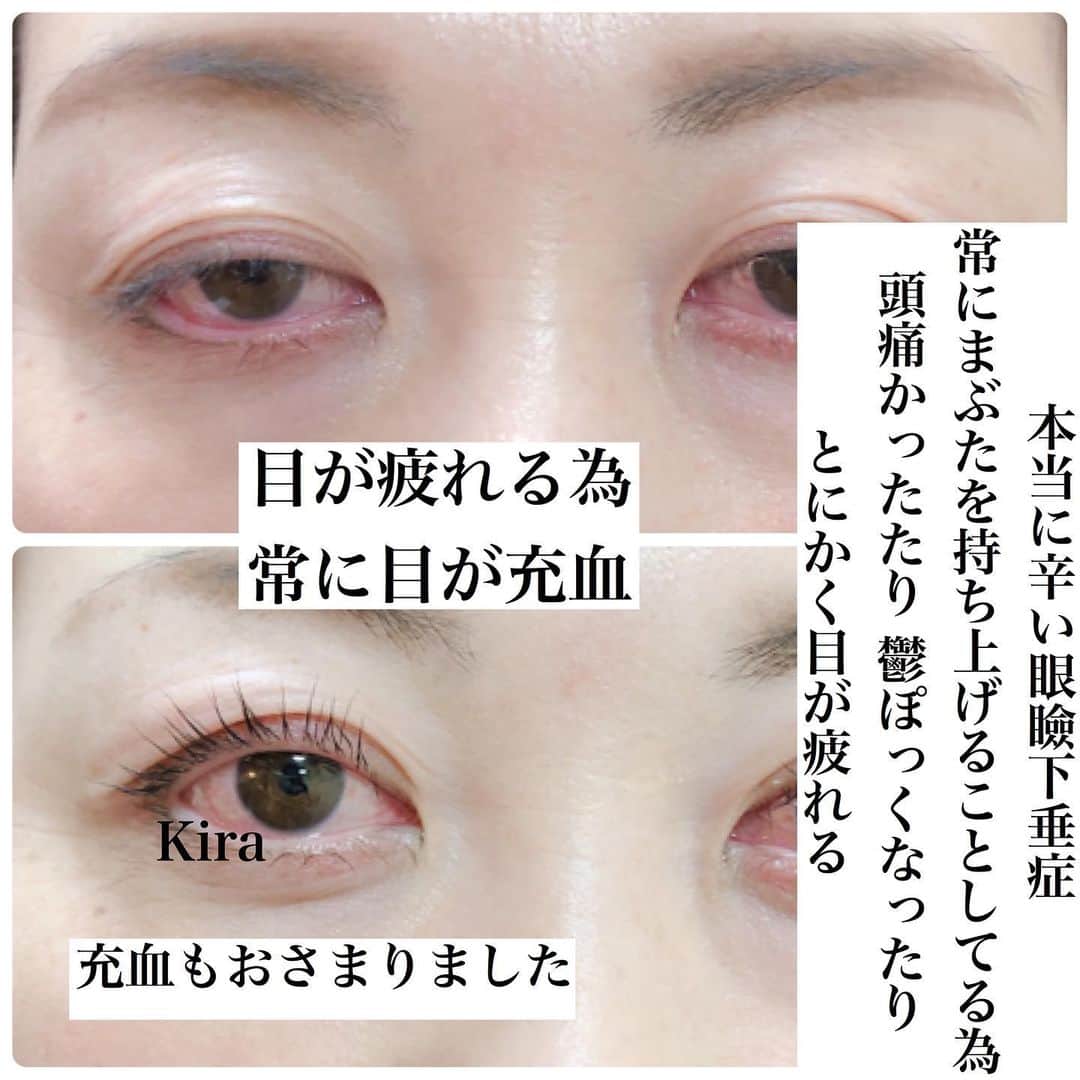 KIRAさんのインスタグラム写真 - (KIRAInstagram)「さまざまな眼瞼下垂症  眼瞼挙筋などに直接異常が生じる「真の眼瞼下垂」とは異なり、「偽性眼瞼下垂」と呼ばれる病態もあります。顔面神経麻痺やまぶたのけいれんが原因で発生することもありますが、圧倒的に多いのが眼瞼皮膚弛緩症（まぶたの皮膚のたるみ）です。 眼瞼挙筋などに直接異常が生じる「真の眼瞼下垂」とは異なり、「偽性眼瞼下垂」と呼ばれる病態もあります。顔面神経麻痺やまぶたのけいれんが原因で発生することもありますが、圧倒的に多いのが眼瞼皮膚弛緩症（まぶたの皮膚のたるみ）です。  整形が抵抗ある方は 絶対おすすめです。  本当に楽になります  ご質問・ご相談 気軽にお問い合わせ下さい😊 ・ #まつ毛パーマ #まぶた上げパーマ #ラッシュパーミングアイリスター#ラッシュパーミング#輝式まぶた上げ #眼瞼下垂症#アイリスト#下まつ毛パーマ #仙台アイリスト#仙台まつ毛パーマ#まつ毛パーマセミナー #アイリスト #整形失敗#アイリッドアップパーマ #まつ毛カラー #ラッシュリフト  #アイリッドダウンパーマ #新潟 山形アイリスト#マツエク#まつ毛エクステ  #シリコンロット#韓国eyelash #美容整形 #たるみまぶた #新潟まつ毛パーマ#下まつ毛パーマ#次世代まつ毛パーマ#沖縄まつ毛パーマ #LashPermingeyeListar#Rushlift#整形」5月12日 8時25分 - thekirastory