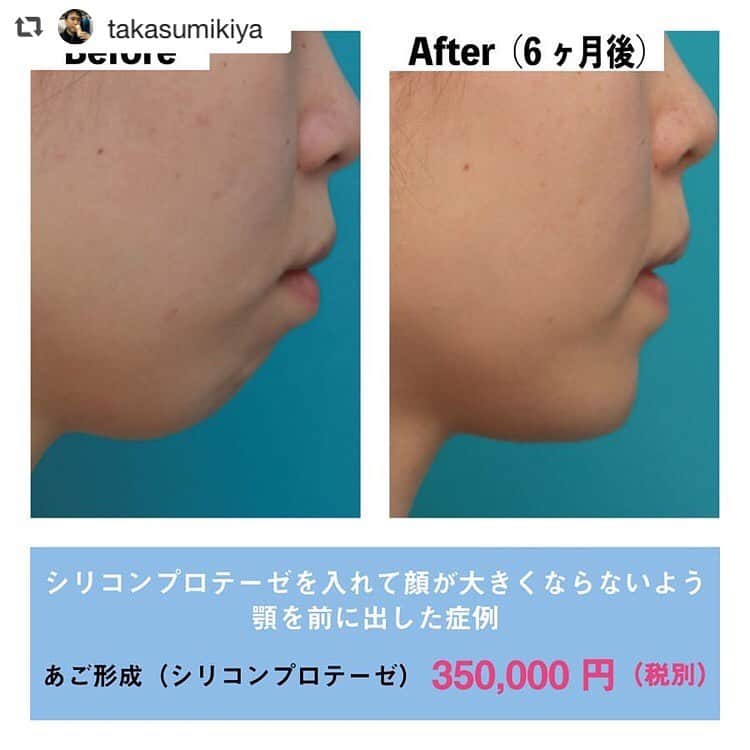 高須クリニック名古屋院さんのインスタグラム写真 - (高須クリニック名古屋院Instagram)「#repost @takasumikiya via @PhotoAroundApp  シリコンプロテーゼを入れて顔が大きくならないように顎を前に出した症例 ・ 20代女性の患者様で、口元が出て、顎が引っ込んでいるのが悩みで来院されました。 出ている口元を引っ込めるためには、上下の歯を4本抜歯して上下顎骨切り手術をするか、同じように上下の歯を4本抜歯して歯科矯正をして下げる方法があります。 ・ 上下顎骨切り手術は大変リスクの高い手術で、歯科矯正を併用せずに美容目的だけで行うのは大きな危険を伴い、術後は3～6ヶ月間強い腫れがあります。 歯科矯正で行う場合は2～3年程度かかることが多く、2年間くらいは上下の歯にブランケットを装着する必要があります。 患者様はそのような治療は希望されず、引っ込んでいる顎を前に出す治療をすることになりました。 ・ 顎が下に延びて顔が縦に長くならないように、顎が前方に出るように約8mmのプロテーゼを入れました。 顎先が丸くなったり四角くなったりしないように、適度に先端が尖ったプロテーゼを使用しました。 ・ 術後は引っ込んでいた顎が前に出て、口元が出ているのが目立たなくなりました。 横から見ると、エステティックライン（Eライン）上よりもやや顎が引っ込んでいますが、口元が出ている人に顎を出してEラインを真っ直ぐにしようとすると、顎が長くなりすぎるため、これくらいがちょうど良いと思います。 ・ 【料金】 ●あご形成（シリコンプロテーゼ）：350,000円（税別） ※料金は2019年4月30日現在 ※保険適用外、自由診療 ・ 【リスク・副作用など】 ●腫れ（術後） ●仕上がりのわずかな左右差（完璧なシンメトリーは不可） ●仕上がりが完璧に自分の理想の形にならないことがある ●感染 ・ 【ご予約・お問い合わせ】 名古屋院☎︎ 052-564-1187 名古屋院📱 @takasuclinic_nagoya ↑名古屋院インスタのプロフィール画面からも直接コンタクトが取れます📲 https://www.takasu.co.jp/ ・ ・ #高須クリニック #高須クリニック名古屋院 #高須幹弥 #高須英津子 #美容整形 #整形 #二重 #埋没法 #二重切開 #ヒアルロン酸 #鼻 #ニキビ #ニキビ跡 #たるみ #眼瞼下垂 #シワ #ほうれい線 #整形したい #美容好きな人と繋がりたい #可愛くなりたい #綺麗になりたい #平行二重 #末広二重 #プチ整形 #二重整形 #目尻切開 #目頭切開 #ビフォーアフター」5月28日 17時26分 - takasuclinic_nagoya