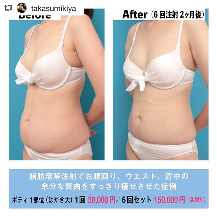 高須クリニック名古屋院さんのインスタグラム写真 - (高須クリニック名古屋院Instagram)「#repost @takasumikiya via @PhotoAroundApp  脂肪溶解注射イタリアンメソシェイプでお腹回り、ウエスト、背中の余分な贅肉をすっきり痩せさせた症例 ・ 20代女性の患者様で、お腹回りの贅肉を取りたいというご要望で来院されました。 診察させていただいたところ、お腹回り全体（上腹部、下腹部、ウエスト、背中、腰）にかなりの皮下脂肪がついており、触診すると、手のひらでガバッと大量の皮下脂肪を摘まむことができました。 これくらいの量の皮下脂肪がある場合、脂肪吸引で一度に大量の皮下脂肪を除去してしまうことも可能です。 しかし患者様は、「脂肪吸引はなんとなく恐いので、脂肪溶解注射イタリアンメソシェイプとかの脂肪吸引以外の方法でなんとかしてほしい」というご要望でした。 ・ 脂肪吸引以外の脂肪を取る痩身治療には、脂肪溶解注射イタリアンメソシェイプ、脂肪を凍らせる方法、超音波、高周波など様々なものがありますが、それらの中では脂肪溶解注射イタリアンメソシェイプが最も効果が大きいため、脂肪溶解注射イタリアンメソシェイプを行うことになりました。 ・ 大量の皮下脂肪が摘まめるお腹回り全体（上腹部～下腹部～ウエスト～背中～腰）の広い範囲に満遍なく脂肪溶解注射イタリアンメソシェイプを注射するプロトコールで1クール（6回）治療しました。 ・ 治療後は、お腹回り全体が一回り細くなってすっきりしました。 まだ多少皮下脂肪は残っており、わずかに余分な贅肉を摘まむことができるのですが、もう1クール同じ部位に脂肪溶解注射イタリアンメソシェイプを行うと更に一回り細くすることができます。 ・ 痩身のカウンセリングをしていると、時々、「脂肪吸引と脂肪溶解注射イタリアンメソシェイプだと、どちらがたくさんの脂肪が取れますか？」とご質問いただきますが、それは、ついている脂肪の量、範囲、脂肪溶解注射イタリアンメソシェイプの治療回数などによって様々であり、ケースバイケースなので、一概に答えられることではありません。 ・ この患者様のお腹回りに関しては、1回の脂肪吸引で取れる脂肪の量は、脂肪溶解注射イタリアンメソシェイプ2クール分くらいになるので、料金的なことだけをいえば、脂肪吸引だと90万円くらい、脂肪溶解注射イタリアンメソシェイプだと180万円くらいかかり、脂肪吸引のほうが安いということになります（あくまで一定の料金当たりの取れる脂肪の量だけの話ですが） ・ 【料金】 ●脂肪溶解注射イタリアンメソシェイプ ボディ1部位（はがき大）1回：30,000円（税別）／6回セット：150,000円（税別） 両頬1回：60,000円（税別） あご下～フェイスライン1回：60,000円（税別） ※顔の場合は、1～3回程度で十分な効果が出ます ※料金は2019年4月27日現在 ※保険適用外、自由診療 ・ 【リスク・副作用など】 ●内出血（注射針が血管に当たってしまった場合） ●アレルギー症状（パイナップルアレルギーの方） ・ 【ご予約・お問い合わせ】 名古屋院☎︎ 052-564-1187 名古屋院📱 @takasuclinic_nagoya ↑名古屋院インスタのプロフィール画面からも直接コンタクトが取れます📲 https://www.takasu.co.jp/ ・ ・ #高須クリニック #高須クリニック名古屋院 #高須幹弥 #高須英津子 #美容整形 #整形 #二重 #埋没法 #二重切開 #ヒアルロン酸 #ダイエット #ニキビ #痩身 #たるみ #眼瞼下垂 #シワ #ほうれい線 #毛穴 #目 #整形したい #美容好きな人と繋がりたい #可愛くなりたい #綺麗になりたい #平行二重 #末広二重 #プチ整形 #二重整形 #目尻切開 #目頭切開」5月14日 10時46分 - takasuclinic_nagoya