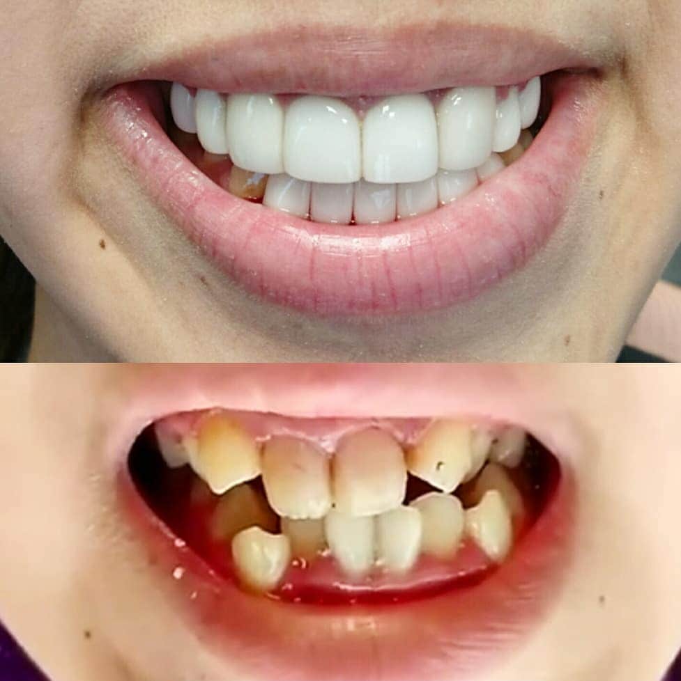 のインスタグラム：「この歯と歯並びも直しました❗ @superdentist5  スーパーベニアとジルコニアセラミッククラウンのコンビネーションです  今までは、綺麗に直せなかった歯と歯並びは ありません (歯がない場合は外注でインプラントでつくります)  上下前歯の神経は取ってますが 歯は１本も抜いてません  料金(税抜き) スーパーベニア １本  90000円 ジルコニアセラミッククラウン １本  100000円  歯の状態で別途治療費がかかります  メリット 歯科矯正では絶対に綺麗にならない歯と 歯並びも綺麗に直せます デメリット 上下直すと高額になる 副作用 特にありません  #amazing#artist#dentist#superman #dentalclinic#magic#god#model#yoga #マジック#審美歯科#セラミック#ヨガ #神業#デンタルクリニック#六本木#銀座 #コスメ#美容#美容整形#エステ#モデル #ミスコン#脱毛#フィットネス」