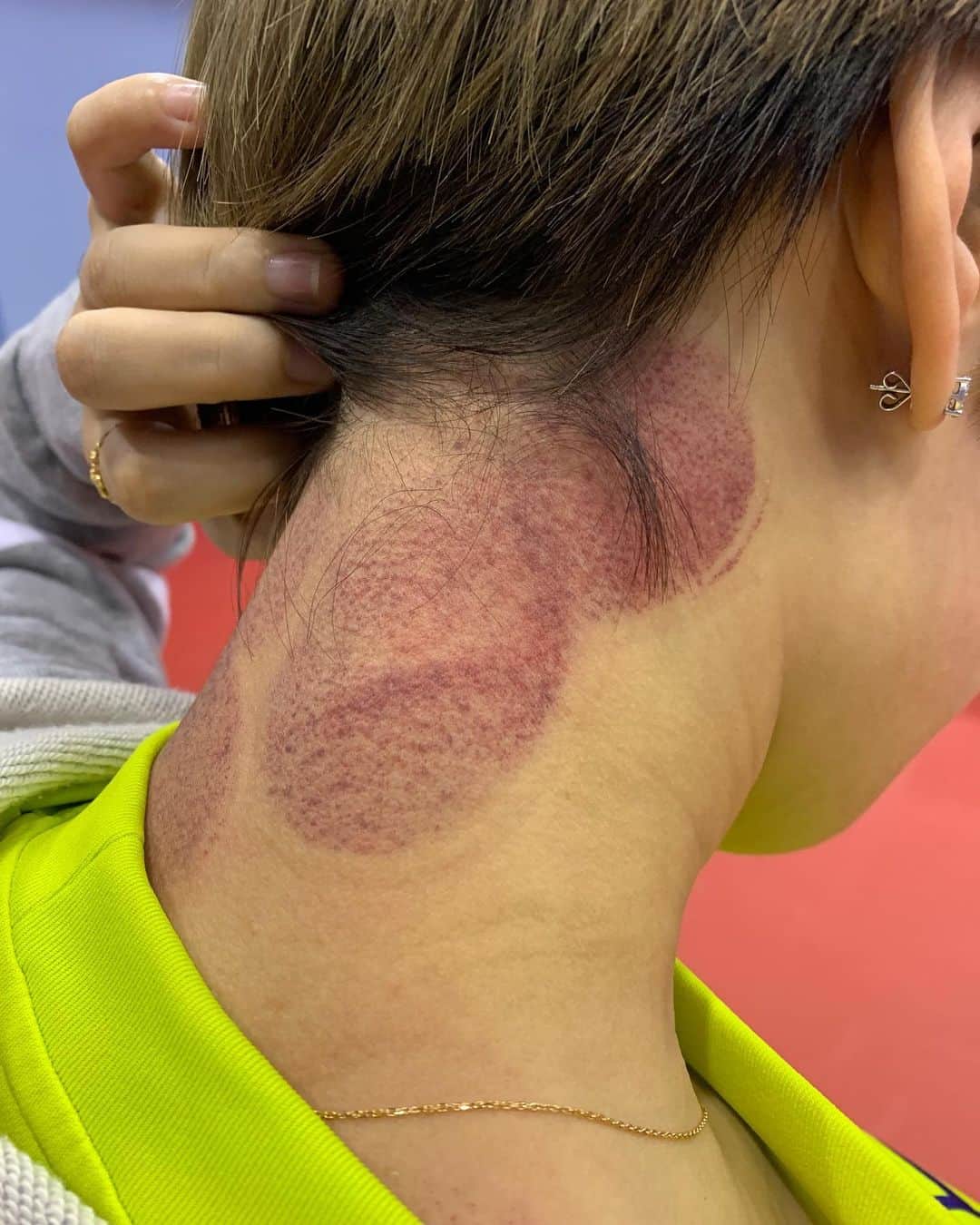 チョン・ジャーチーのインスタグラム：「#cupping #acupuncture」