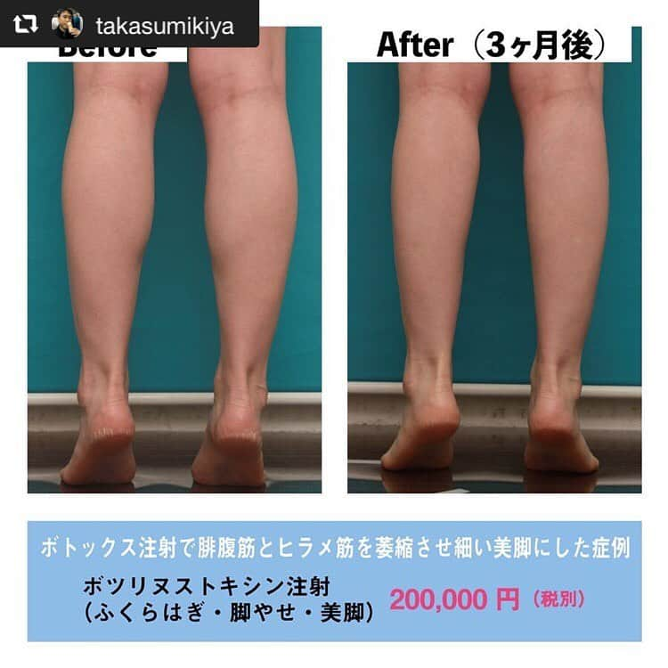 高須クリニック名古屋院さんのインスタグラム写真 - (高須クリニック名古屋院Instagram)「#repost @takasumikiya via @PhotoAroundApp  ボトックス注射で腓腹筋とヒラメ筋を萎縮させ、細い美脚にした症例 ・ 20代女性の患者様で、ふくらはぎを細くしたいというご要望でした。 診察させていただいたところ、ふくらはぎの太さは日本人の平均くらいで、特別太いほうではありませんでした。 しかし患者様は、「私のふくらはぎは太いんです」「もっと、モデルさんみたいに細い脚になりたいんです」とおっしゃっていました。 確かに、日本人の平均の太さのふくらはぎでも、一流のモデルさんやK-POPアイドルなどに比べれば、かなり太いほうになります。 ・ この患者様のふくらはぎは、筋肉によるものが8割くらいを占め、皮下脂肪や浮腫みによるものはわずかだったので、筋肉を萎縮させて筋肉を細くするために、ボツリヌストキシン注射をすることになりました。 発達して太くなっている腓腹筋とヒラメ筋を中心に注射しました。 ・ 術後はふくらはぎの発達している筋肉がほどよく細くなりました。 ふくらはぎが日本人の平均レベルの細さでも、「私、ふくらはぎが太いのが悩みなんです」と来院される方は多いです。 日本人の平均でも、テレビや雑誌で活躍するモデルさんや女優さん、K-POPアイドルなどに比べると、太いほうになってしまいます。 そのような方はボツリヌストキシン注射で、発達している筋肉を一回り細くしてさしあげると喜んでいただけることが多いです。 ・ 【料金】 ●ボツリヌストキシン（ボトックス）注射（ふくらはぎ・脚やせ・美脚）：200,000円（税別） ※料金は2019年4月27日現在 ※保険適用外、自由診療 ・ 【リスク・副作用など】 ●内出血（注射針が血管に当たってしまった場合） ●妊活・妊娠・授乳中の方への施術不可 ・ 【ご予約・お問い合わせ】 名古屋院☎︎ 052-564-1187 名古屋院📱 @takasuclinic_nagoya ↑名古屋院インスタのプロフィール画面からも直接コンタクトが取れます📲 https://www.takasu.co.jp/ ・ ・ #高須クリニック #高須クリニック名古屋院 #高須幹弥 #高須英津子 #美容整形 #整形 #二重 #埋没法 #二重切開 #ヒアルロン酸 #ダイエット #痩身 #たるみ #眼瞼下垂 #シワ #毛穴 #目 #整形したい #美容好きな人と繋がりたい #可愛くなりたい #綺麗になりたい #平行二重 #末広二重 #プチ整形 #二重整形 #目尻切開 #目頭切開 #ビフォーアフター」5月17日 10時45分 - takasuclinic_nagoya