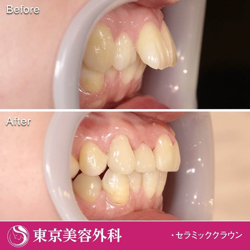東京美容外科公式さんのインスタグラム写真 - (東京美容外科公式Instagram)「出っ歯が気になって来院された、患者様のセラミック矯正の症例写真です。 ㅤㅤㅤㅤㅤㅤㅤㅤㅤㅤㅤ マウスピース（インビザライン）での矯正治療もお考えでしたが、できるだけ早く治療を終わらせたいということで、セラミックでの矯正治療と、なりました。 ㅤㅤㅤㅤㅤㅤㅤㅤㅤㅤㅤ まず仮歯を作り、そこから根の治療を行い、オールセラミックで、仕上げていきます。 ㅤㅤㅤㅤㅤㅤㅤㅤㅤㅤㅤ 今なら仮歯込みで6本38万円（税抜）です。  ご契約の方は🚖ワンメータータクシー代ご負担いたしますので、領収書は必ずお持ちください！ ㅤㅤㅤㅤㅤㅤㅤㅤㅤㅤㅤ 土日祝日も診察受付中！ 予約の状況にもよりますが、当日予約も可能です。 ㅤㅤㅤㅤㅤㅤㅤㅤㅤㅤㅤ 症例モニターも募集しております。 お気軽にご相談ください ㅤㅤㅤㅤㅤㅤㅤㅤㅤㅤㅤ ==🎁お問い合わせはこちら🎁==== 詳しくはプロフィールのURLから公式サイトへ♪ ▼フリーダイヤル 0120-545-871 （コールセンター受付時間：9：00～21：00） ▼LINE予約 @ tkc_shinbi ========================= ㅤㅤㅤㅤㅤㅤㅤㅤㅤㅤㅤ #東京美容外科 #赤坂 #PMTC #歯石除去 #スケーリング #審美 #ホワイトニング #美容整形 #きれい #整形 #美活 #美容外科 #プチ審美歯科 #インビザライン #アンチエイジング #歯科 #美容整形外科 #ジルコニア #全身麻酔 #小顔 #ノンスクラプデンチャー #ヒアルロン酸 #セレック #CEREC #白い歯 #痛くない治療 #セラミック #矯正 #親知らず ㅤㅤㅤㅤㅤㅤㅤㅤㅤㅤㅤ [リスクと術後の注意点] 装着後、咬み合わせがなじむまで、違和感、場合によっては、咬合痛がしばらく続く場合があります。 歯周病などで歯肉が退縮し、歯根が露出してくる場合がありますので、ケアをしっかり行ってください。」5月18日 14時32分 - tokyobiyougeka_jimukyoku
