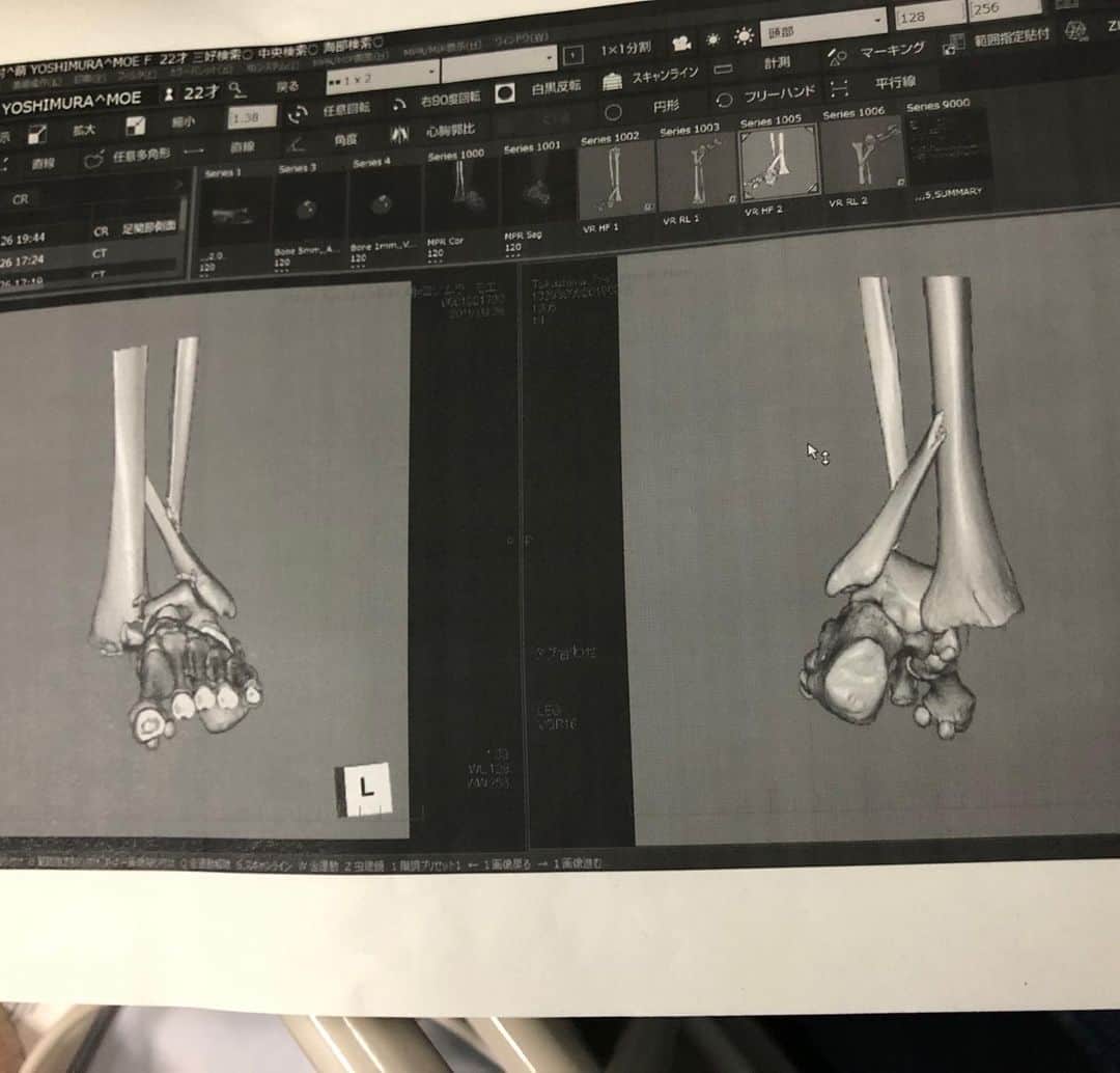 義村萌のインスタグラム：「痛みを忘れないように骨🦴 左足関節開放性脱臼骨折」