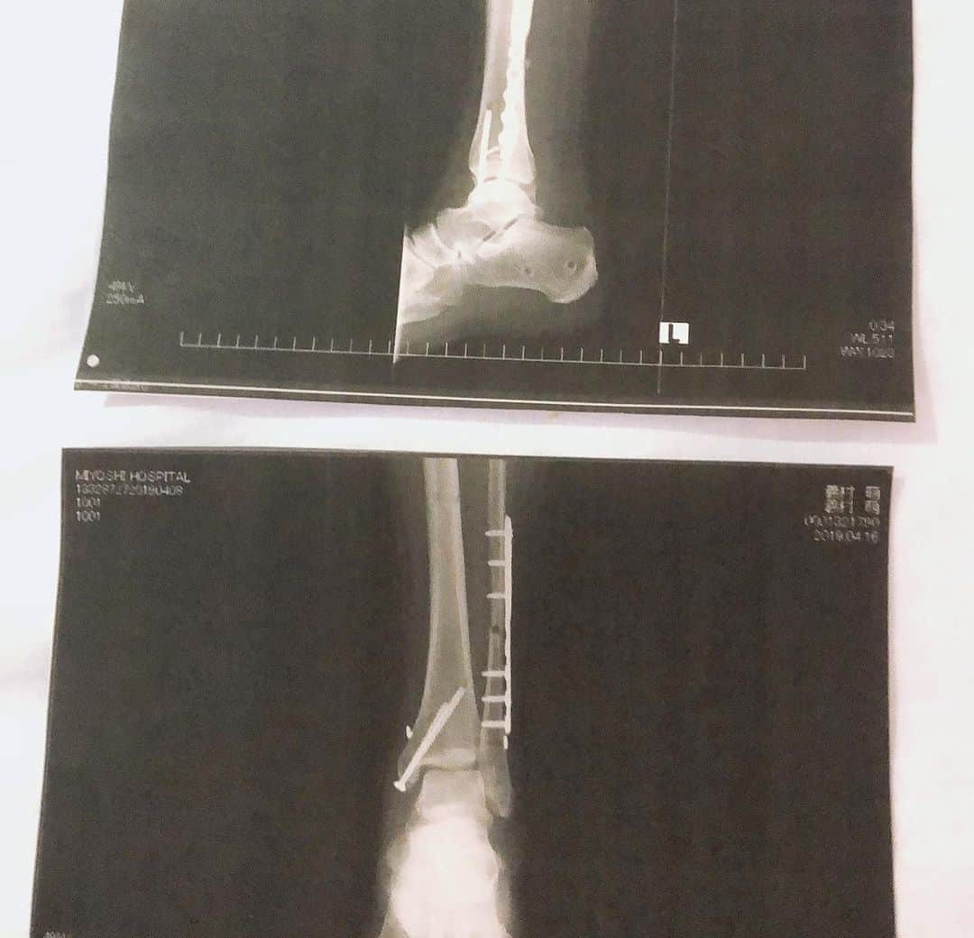 義村萌さんのインスタグラム写真 - (義村萌Instagram)「痛みを忘れないように骨🦴 左足関節開放性脱臼骨折」5月21日 11時33分 - moe.yoshimura