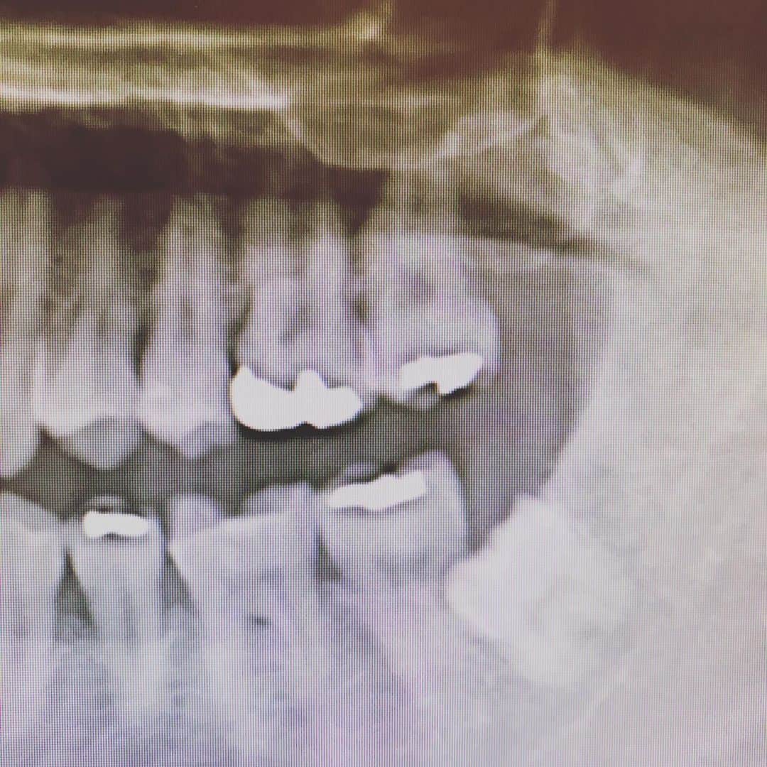 石川龍さんのインスタグラム写真 - (石川龍Instagram)「ピーポくんに遭遇したり、歯の治療をしたりしている、最近です。 #ピーポくん  #親知らず」5月23日 0時09分 - slow_night