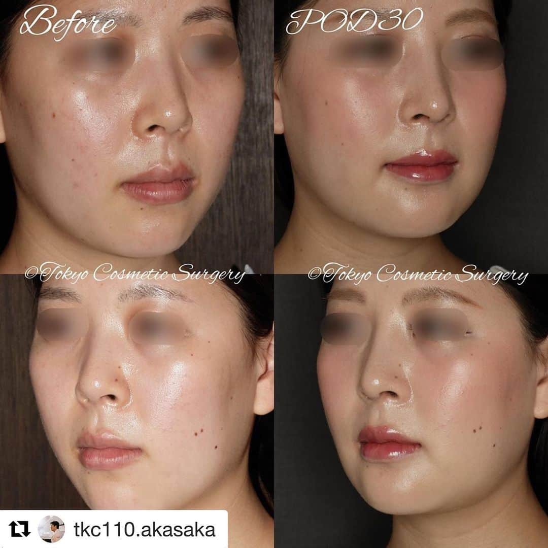 東京美容外科公式さんのインスタグラム写真 - (東京美容外科公式Instagram)「東京美容外科 宮崎先生による症例写真です。 ㅤㅤㅤㅤㅤㅤㅤㅤㅤ 東京美容外科では現在輪郭整形や骨切り手術がお得に受けられるキャンペーンを行っております。 ㅤㅤㅤㅤㅤㅤㅤㅤㅤ 『5月末までのモニター募集』 👉赤坂院 レイスキャン導入記念骨格診断キャンペーン 新しいCT「レイスキャン」を使用した「骨格診断キャンペーン」です！ 通常1回30,000円→4500円 更にこのキャンペーン診断後に骨切り施術契約で、術前検査が通常150,000円→100,000円 ㅤㅤㅤㅤㅤㅤㅤㅤㅤㅤㅤㅤㅤㅤㅤㅤㅤㅤ 👉宮崎先生よる輪郭整形モニター セットバック・OGS　パーツモニター30%OFF ㅤㅤㅤㅤㅤㅤㅤㅤㅤ 👉山本先生よる輪郭整形モニター 骨切りモニター　30%OFF（パーツモニター） ※モニターをご希望で無い場合は、術前検査などオプションが無料となります。 ㅤㅤㅤㅤㅤㅤㅤㅤㅤ 👉木村先生よる輪郭整形モニター 小顔えら骨切り（口外法）パーツモニター30%OFF ㅤㅤㅤㅤㅤㅤㅤㅤㅤ ご予約の際にInstagramを見たとお伝え頂いた方のみ適応させていただきます✨ ㅤㅤㅤㅤㅤㅤㅤㅤㅤ ぜひこの機会にご相談くださいませ。 ㅤㅤㅤㅤㅤㅤㅤㅤㅤ #Repost @tkc110.akasaka with @get_repost ・・・ ・ 先日の続きでご紹介するのは アゴ先を短くして小顔になりたいというリクエストと、 鼻の孔が上を向いて見えているのを変えたいという リクエストの患者様です。 ・ 彼女に行った施術は 「オトガイ形成術」 「頬アゴ下脂肪吸引」 「アジアンライノプラスティ」 （プロテーゼ挿入、鼻尖形成術、鼻中隔延長術） ・ アゴ先は短くして前方に移動させているので、 術前よりもEラインが整い、 下唇からアゴまでの綺麗なくびれのラインを 作る事ができました。 ・ 鼻は元々太い訳ではないのですが、 鼻の孔が上を向いた状態だったので、 穴の見え方を変えるために 鼻中隔軟骨を使って鼻尖形成を行いました。 太さをあまり変えずに鼻先を下に向けるために 軟骨の加工を工夫しています。 鼻尖をただ下に向けるだけではなく、 鼻の孔の形のコントロールがミソです。 ・ 鼻の手術は軟骨の再構築と皮膚との関係の再配置、 caudal rotationとtripod conceptで 考えています。 軟骨を鼻先に足すだけでは バランスを取ることが難しく、 どこかに無理がかかったりすると思います。 ・ 🎯🎯骨切りと鼻の手術の組み合わせは、内容により可能です。頰骨骨切り術やオトガイ形成術でしたら、同時に行う事ができます。 ⏱⏱おとがい形成は1時間から1時間30分。鼻の手術は2時間程度です。 ⏳⏳術後の腫れは2週間程度経過すると、7割以上の腫れが引いています。 💰💰オトガイ形成術998,000円、鼻尖形成術＋軟骨移植800,000円、鼻中隔延長1,000,000円 ・ 🎉🎉🎉🎉🎉🎉🎉 ・ ・ ・ ＊結果には個人差があります。内出血や感染などの合併症を認めた場合、治癒期間に差が出ます。合併症に伴う経過についてはカウンセリングの際に説明しますので、十分納得の上で施術をご検討ください。 ・ ・ 💉 Dr. Kunio Miyazaki performed a bone surgery with geniopalsty  and asian rhinoplasty. 📸 These after pictures were taken 30days after the surgery. ・ Facial contouring surgery ・ Dr. Kunio Miyazaki 東京美容外科 赤坂院 Tokyo Cosmetic Surgery Akasaka branch ・ #bonesurgery #facialcontouring #rhinoplasty  #aestheticsurgery #natural #morenatural #morenaturalbeauty#akasaka #骨切り手術 #骨切り #両顎手術 #両顎 #ガミースマイル #受け口 #小顔 #小顔整形 #小顔矯正 #小顔効果 #美容 #美容外科 #美容外科医 #赤坂 #モニター募集 #レイスキャン #ct #モニター #小顔モニター #鼻整形  #面長カバー」5月23日 14時53分 - tokyobiyougeka_jimukyoku