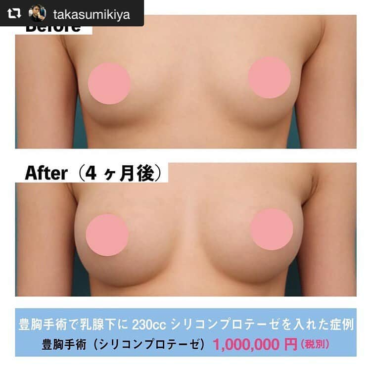 高須クリニック名古屋院さんのインスタグラム写真 - (高須クリニック名古屋院Instagram)「#repost @takasumikiya via @PhotoAroundApp  豊胸手術で乳腺下に230ccシリコンプロテーゼを入れた症例 ・ 20代女性の患者様で、豊胸手術を希望されていました。 診察させていただいたところ、バストのボリュームはさほどなく、日本人女性の平均サイズよりやや小さめでした。 また、バストの上のほうのボリュームが特になく、貧弱な胸が強調されていました。 ・ 患者様は、バストを2カップ以上大きくしたく、最初からシリコンプロテーゼによる豊胸手術を希望されていました。 カウンセリングで話し合った結果、230ccのコヒーシブシリコンジェルバッグのハイプロファイルタイプを乳腺下に入れることになりました。 ・ 手術は全身麻酔で日帰りで行いました。 手術後は小さかった胸が2カップ半程度大きくなり、セクシーで張りとボリュームのある自然で美しいバストになりました。 ・ 【料金】 ●シリコンプロテーゼ（豊胸手術） 1,000,000円（税別） ※料金は2019年3月18日現在 ※保険適用外、自由診療 ・ 【リスク・副作用など】 ●形や感触が不自然になる（サイズの合わないバッグを入れた場合） ・ 【ご予約・お問い合わせ】 名古屋院☎︎ 052-564-1187 名古屋院📱 @takasuclinic_nagoya ↑名古屋院インスタのプロフィール画面からも直接コンタクトが取れます📲 https://www.takasu.co.jp/ ・ ・ #高須クリニック #高須クリニック名古屋院 #高須幹弥 #高須英津子 #美容整形 #整形 #二重 #埋没法 #二重切開 #ヒアルロン酸 #鼻 #ニキビ #ニキビ跡 #豊胸 #眼瞼下垂 #毛穴 #目 #整形したい #美容好きな人と繋がりたい #可愛くなりたい #綺麗になりたい #平行二重 #末広二重 #プチ整形 #二重整形 #目尻切開 #目頭切開 #ビフォーアフター」5月23日 15時57分 - takasuclinic_nagoya