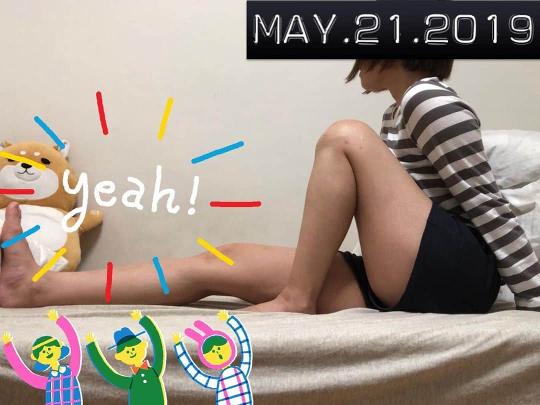 のインスタグラム：「2019.05.21 【術後69日目 / 69 days after surgery】 I “partially” graduated from wearing knee brace, except at crowded places (and Tokyo is pretty crowded everywhere🤣) ・ 先日の定期検診で、膝の装具を外す許可を『限定付き』で頂きましたー‼️🙌(人混みや電車では安全のためにまだ着けます) ・ 私もいきなり卒業するのは不安だから、先生からの『限定付き』の提案に即賛成www ・ 経過も先生が想像していたよりも順調みたいなので一安心✨(「もっと苦労するかと思ってたけど」って一言には笑った。でも、順調だからこそ出た言葉だよね😋) ・ ジョギングはあと1カ月はお預けだけど、これも安全を考慮してのこと。焦りは禁物。先生の指示にはしっかり従って、許可されている範囲内で引き続き頑張るぞ💪 ・ ちなみに、膝曲げの方も140度までやっときたー‼️🎉 ・ 筋トレも頑張って、来月には段差の高い階段でもスムーズに降りられるようになるぞー😤 ・ #努力は絶対裏切らない #ろぎ子の復活までの記録 #膝脱臼 #複合靭帯損傷 #前十字靭帯断裂 (ACL) #後十字靭帯断裂 (PCL) #内側側副靱帯断裂 (MCL) #内側膝蓋大腿靭帯断裂 (MPFL)  #前十字靭帯再建 #後十字靭帯再建 #半月板縫合 #半月板部分切除 #nevergiveup #roadtorecovery #kneeinjury #kneeinjuryrecovery #kneeinjuryrehab #multipleligamenttears #aclrecovery」