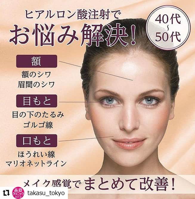 高須クリニックさんのインスタグラム写真 - (高須クリニックInstagram)「. ━･･━･･━･･━･･━･･━･･━ #Repost @takasu_tokyo ━･･━･･━･･━･･━･･━･･━ 注射式シワ取り 長期持続型ヒアルロン酸注射﻿ ﻿ 加齢とともに目立ちはじめた小じわや深いしわを気軽に改善するなら、ヒアルロン酸注射。﻿ 注射1本のお試し感覚で、ダウンタイムもなし。﻿ 10分程で施術が完了した後は、そのままメイクをして普段通りに生活することができます。﻿ 「メイクを変えた？」と聞かれるほどさり気ない仕上がりは、「バレずにきれいになりたい」という女性にも心強い味方です。﻿ ﻿ 【🌿料金】﻿﻿﻿﻿﻿﻿﻿﻿﻿ 1本￥100,000（税抜）﻿﻿﻿ ﻿﻿﻿﻿﻿﻿﻿﻿ 【⚠️副作用・リスク】﻿﻿﻿﻿﻿﻿﻿﻿﻿ 内出血（注射針が血管に当たってしまった場合）、仕上がりのわずかな左右差（完璧なシンメトリーは不可）、アレルギーが生じる可能性 注入後の感染 血流不全、皮膚壊死 過度にいじったり揉んだりすると腫れる可能性﻿﻿﻿ ﻿﻿﻿﻿﻿﻿﻿﻿ 【ご予約・お問合せ】﻿﻿﻿﻿﻿﻿﻿﻿﻿﻿﻿﻿﻿﻿﻿﻿﻿﻿﻿﻿﻿ ➿0120-5587-15﻿﻿﻿﻿﻿﻿﻿﻿﻿﻿﻿﻿﻿﻿﻿﻿﻿﻿ ﻿﻿﻿﻿﻿﻿﻿﻿﻿﻿﻿﻿﻿﻿﻿﻿﻿﻿﻿﻿﻿﻿﻿﻿﻿﻿﻿ #高須クリニック　#高須克弥　#美容　#美容整形　#整形手術　#整形　#プチ整形　#整形したい　#美容外科　#美容クリニック　#東京　#かわいい　#可愛くなりたい　#綺麗　#綺麗になりたい　#美人　#美容好きな人と繋がりたい　#美容好き　#目もと　#額　#おでこ　#眉間　#ほうれい線　#マリオネットライン　#シワ　#シワ取り　#ヒアルロン酸　#自然　#ナチュラル」6月18日 17時08分 - takasu_staff