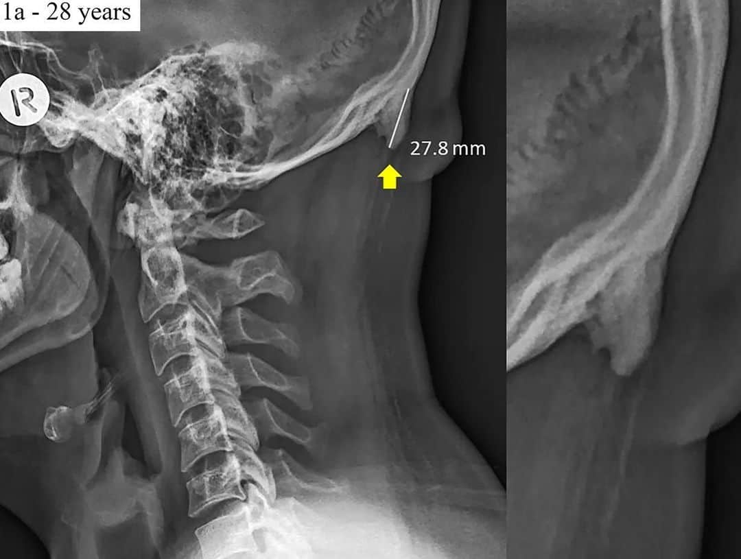 NBC Newsさんのインスタグラム写真 - (NBC NewsInstagram)「Horn-like bone spurs are appearing in young people's skulls. The cause? It might be their smartphones. Click the link in our bio to read more. . 📷 Scientific Reports」6月21日 4時27分 - nbcnews